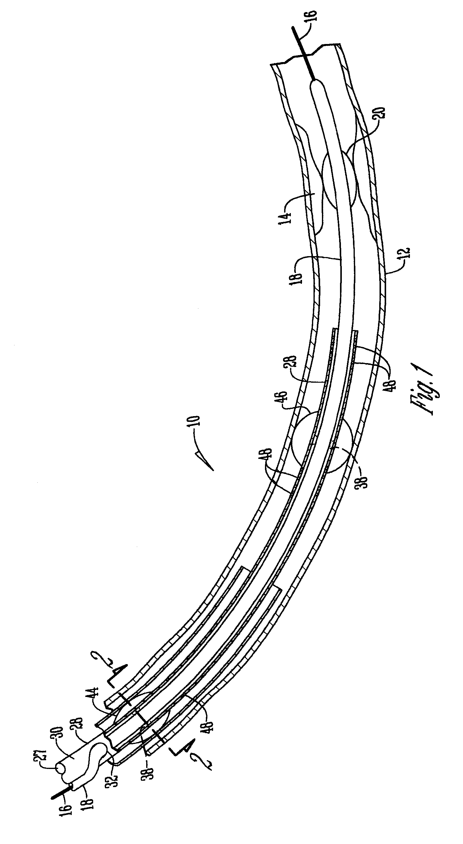 Angioplasty method and means for performing angioplasty