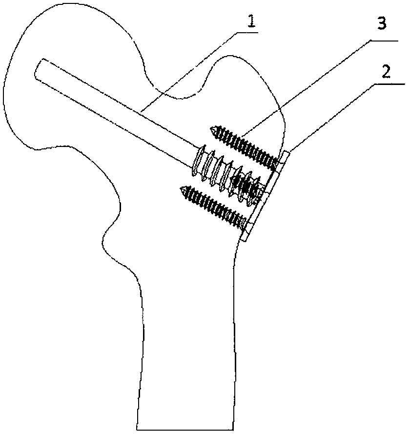 Hollow titanium rod with depinning-resistant device for supporting femoral head to prevent collapse