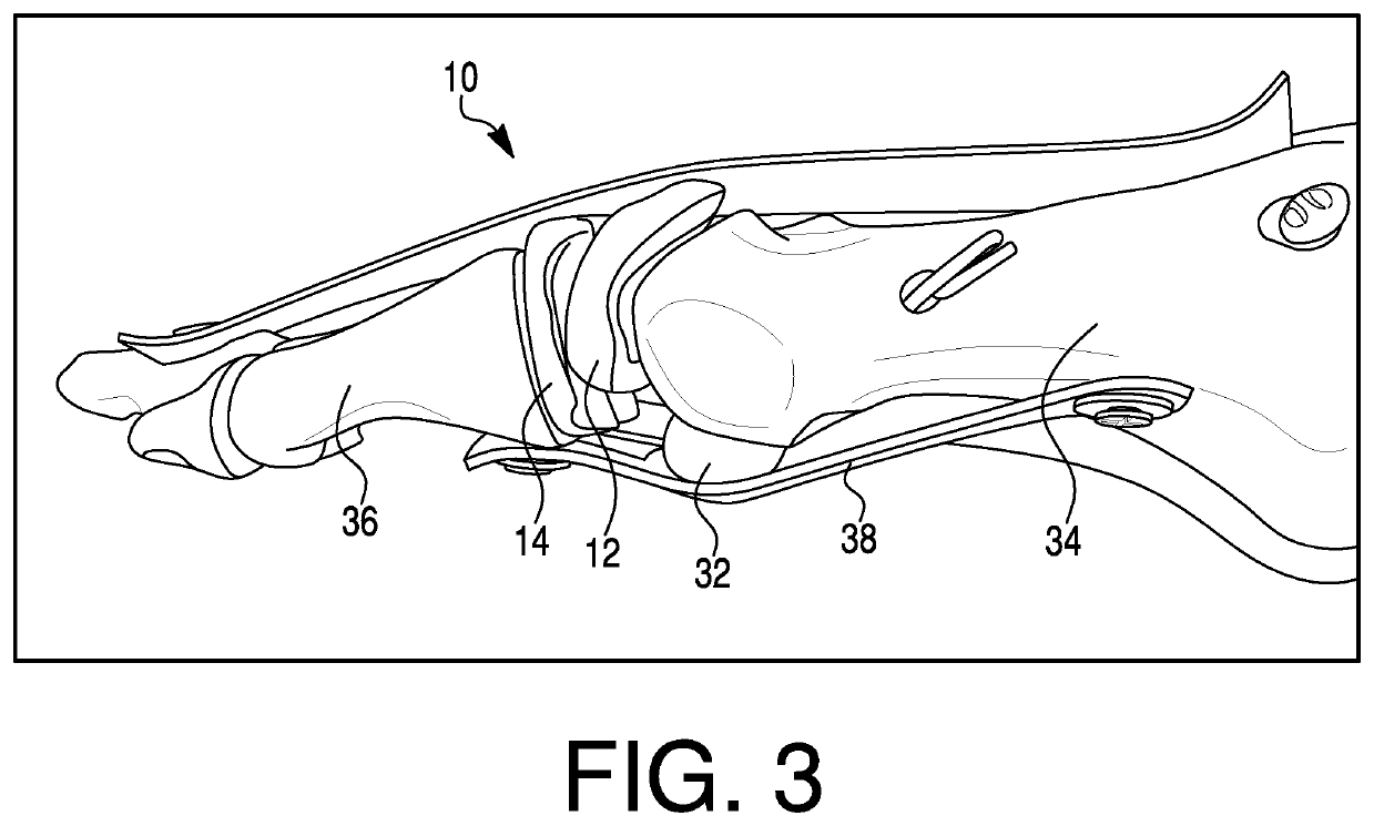 First metatarsophalangeal joint implant and method for placement