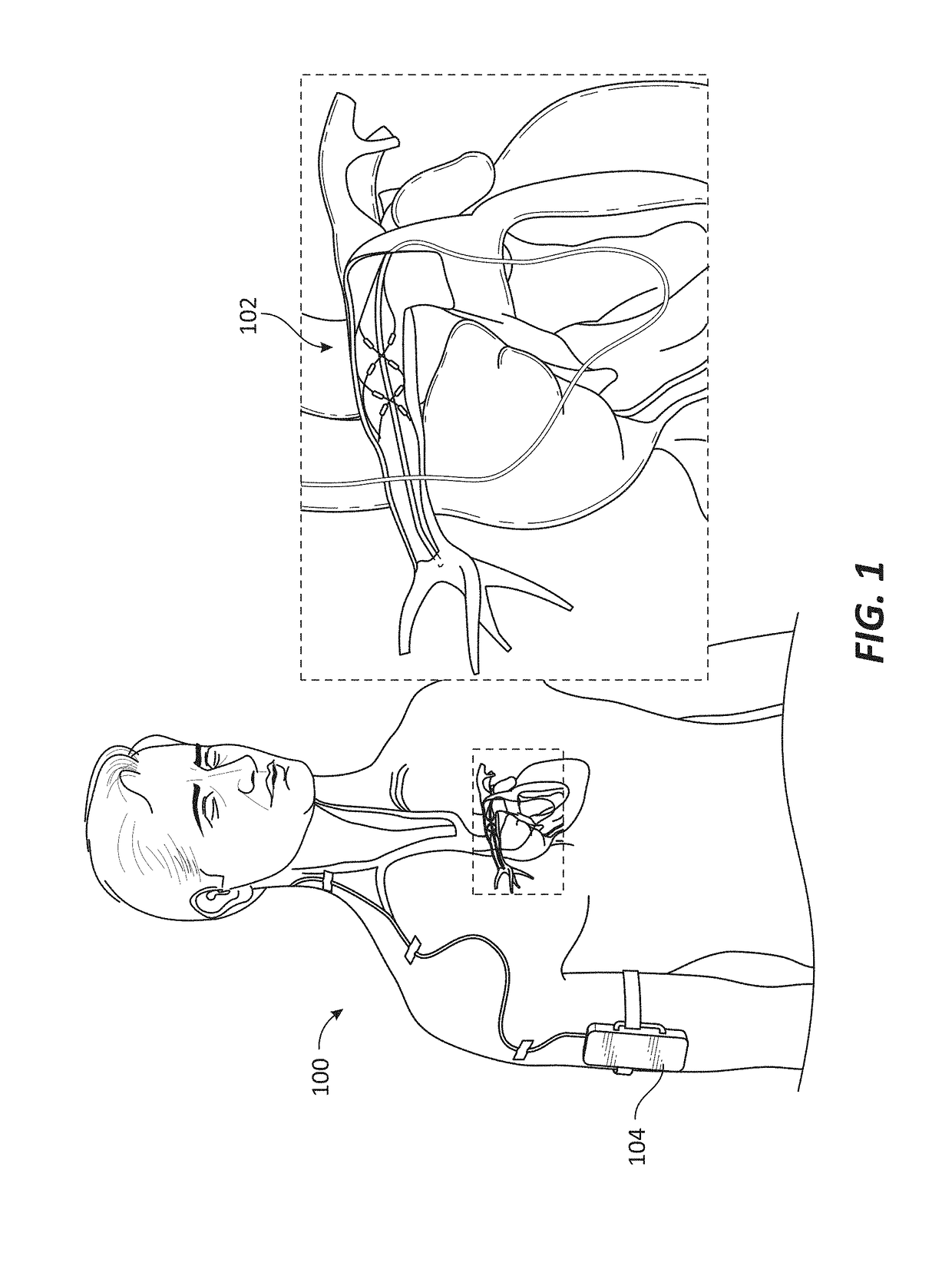 Methods of monitoring effects of neurostimulation