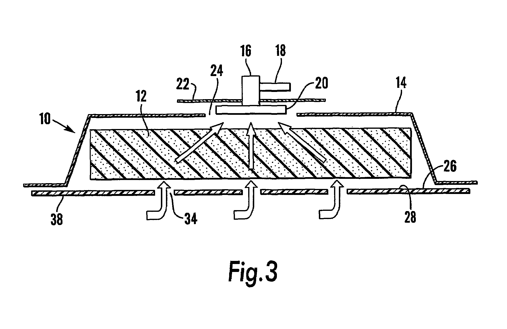 Removable wound closure