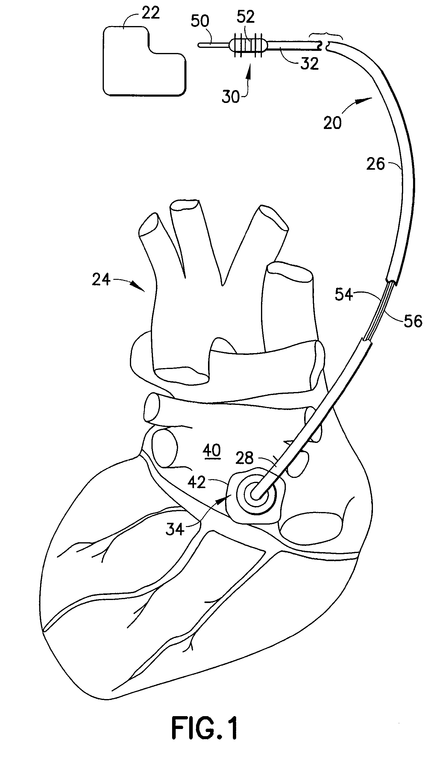 Lead for AV nodal vagal stimulation through an epicardial fat pad