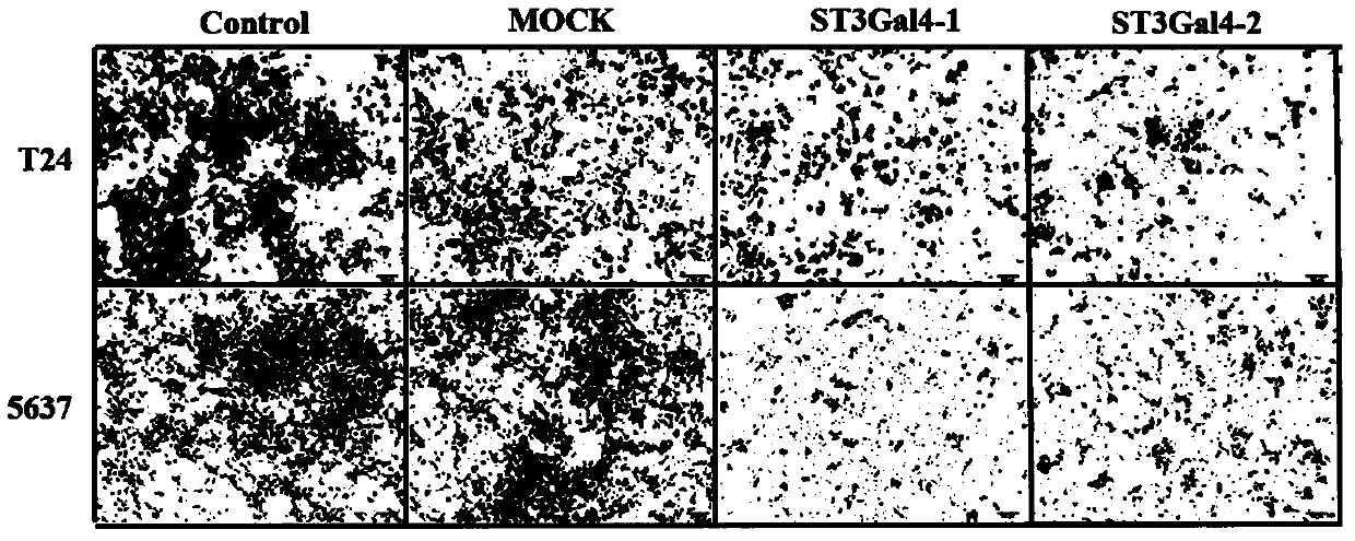 Sialyltransferase recombinant plasmid and application of sialyltransferase recombinant plasmid and pemetrexed the preparation of medicament for inhibiting proliferation and invasion of bladder cancer