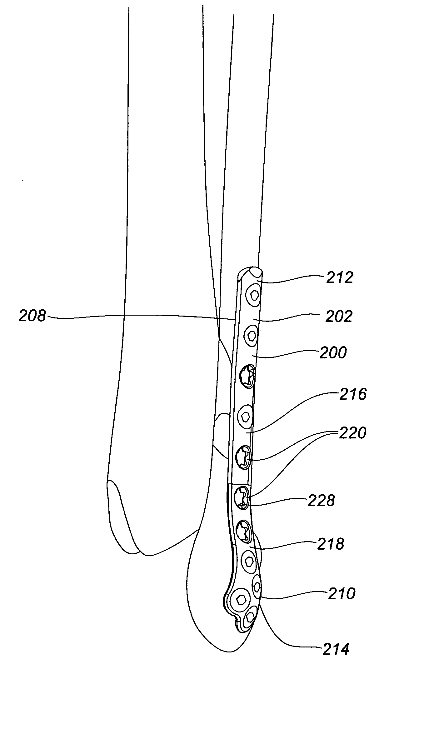 Systems and methods for using polyaxial plates