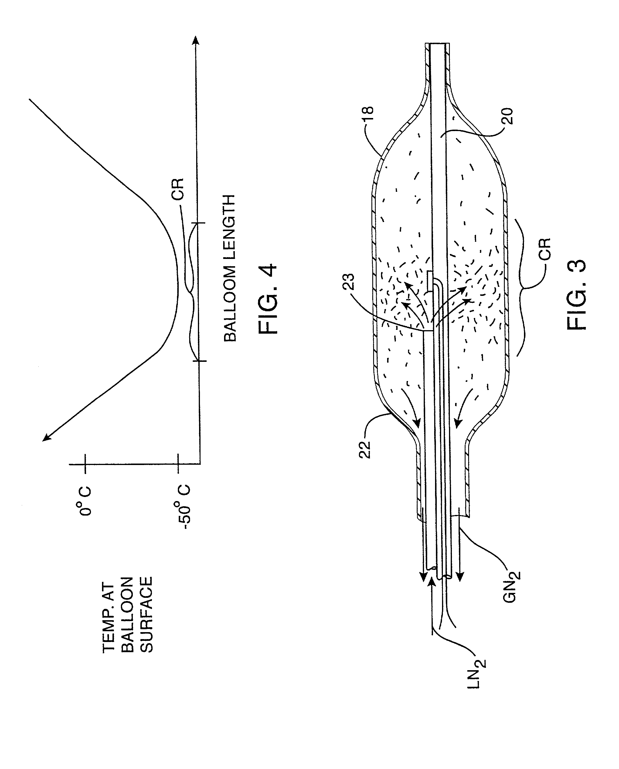 Apparatus and method for cryogenic inhibition of hyperplasia