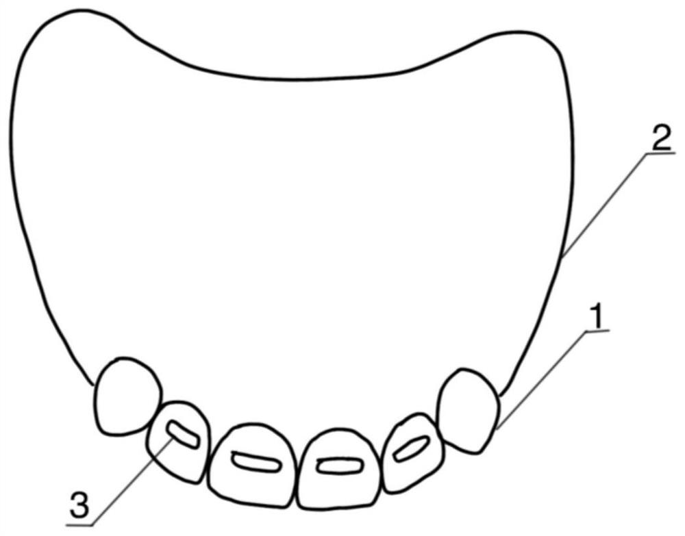 Maxillary edentulous jaw tray with aesthetic forecasting function