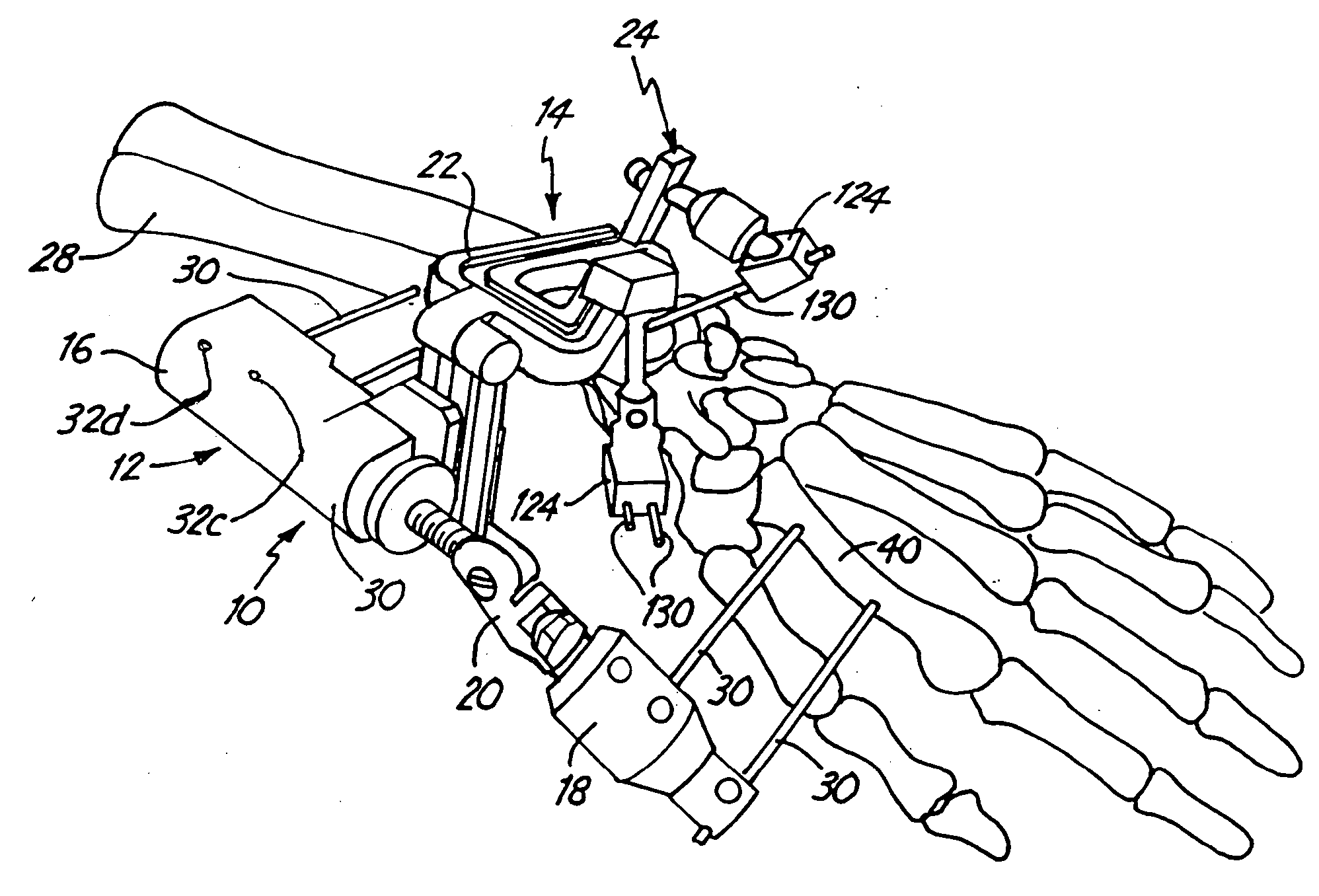 Method Of Fracture Fixation