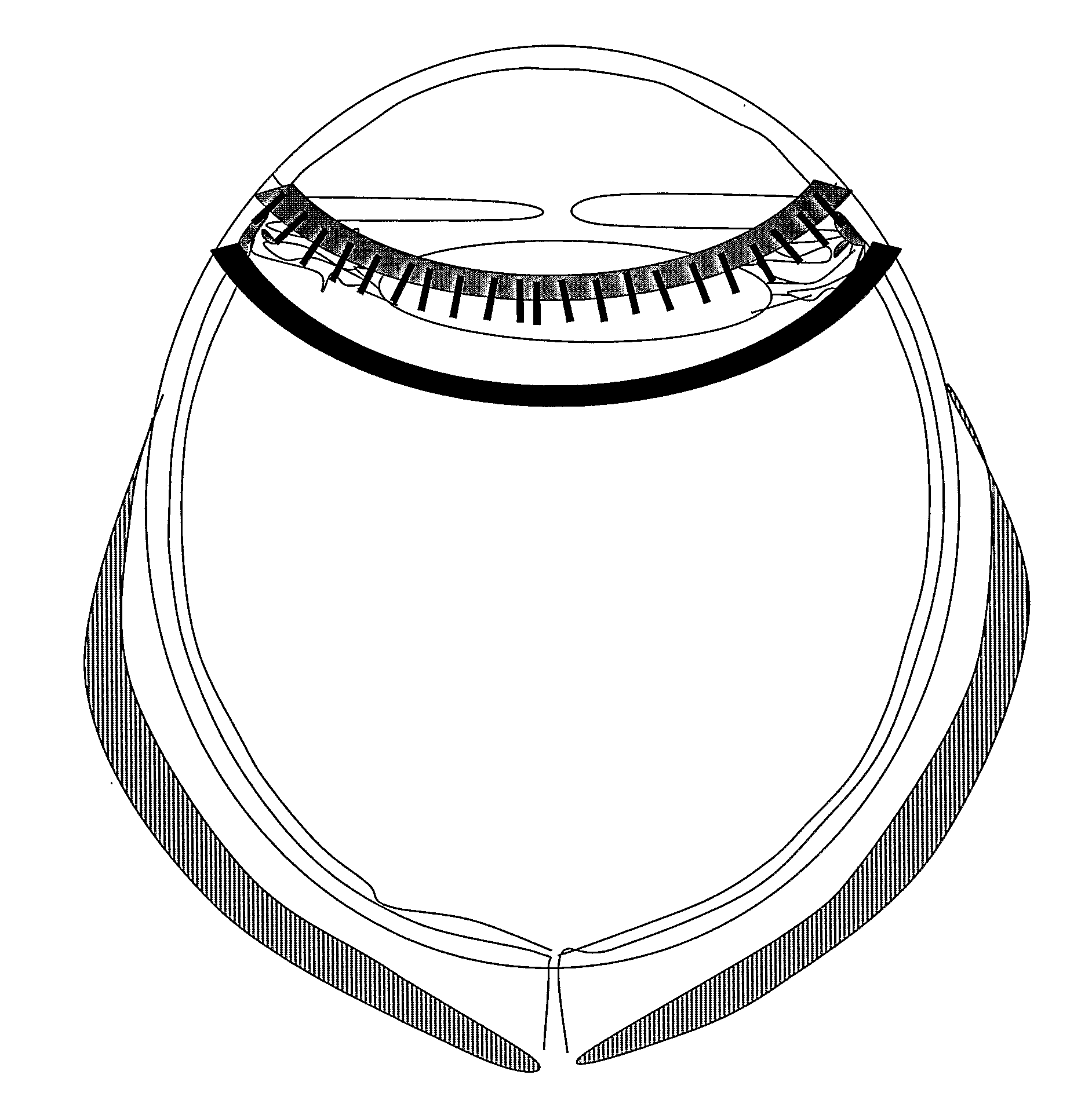 Methods And Devices For Delivering A Therapeutic Product To The Ocular Sphere Of A Subject