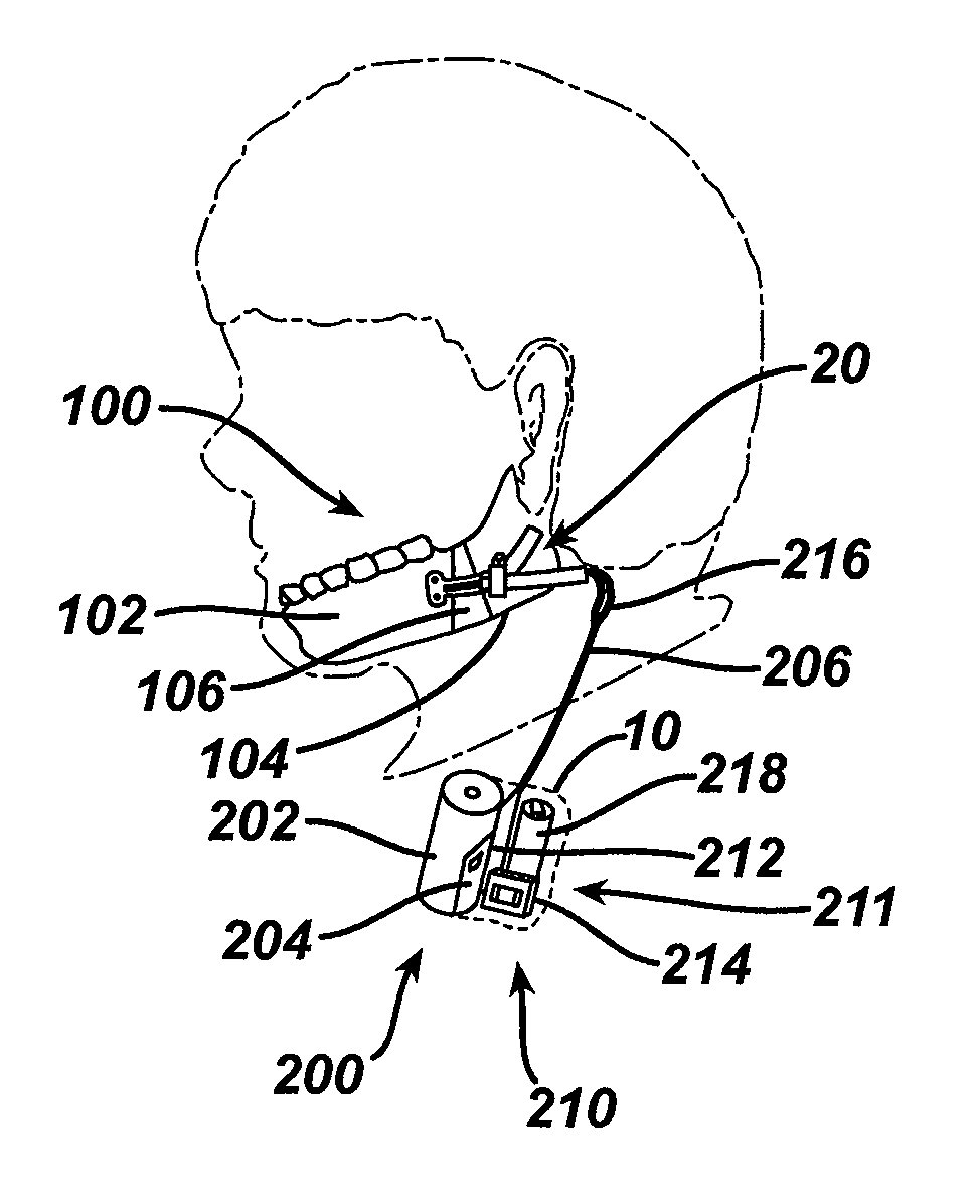 Distraction osteogenesis methods and devices