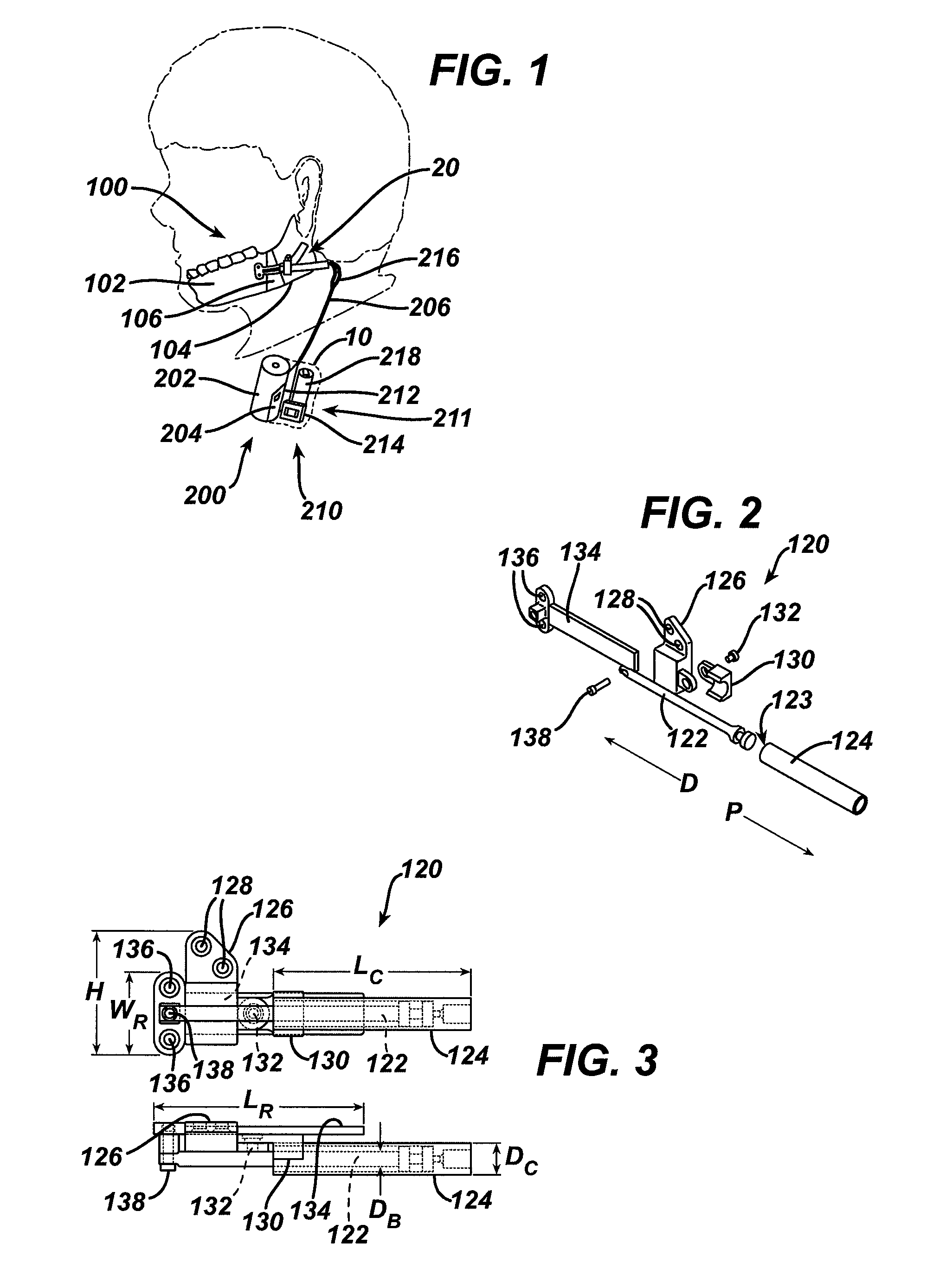 Distraction osteogenesis methods and devices