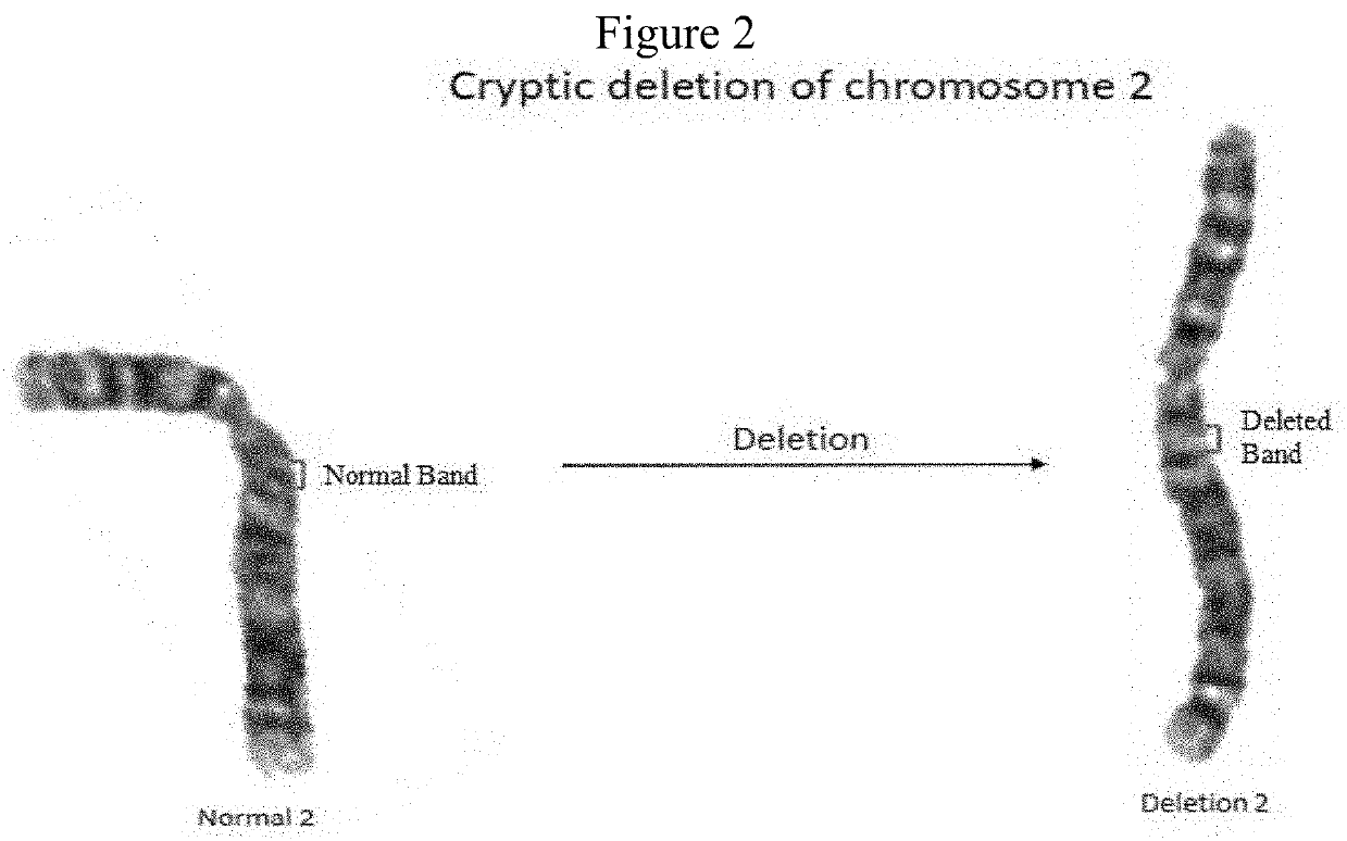 Chromosomal enhancement and automatic detection of chromosomal abnormalities using chromosomal ideograms