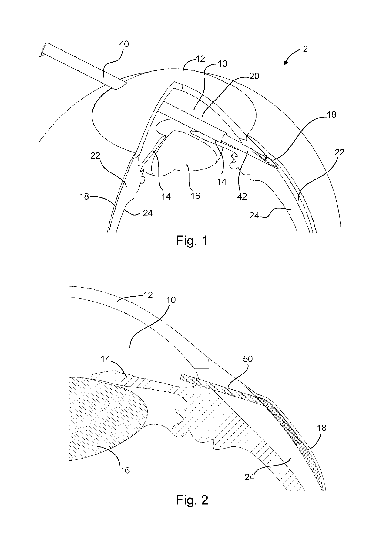 Adjustable intraocular implant