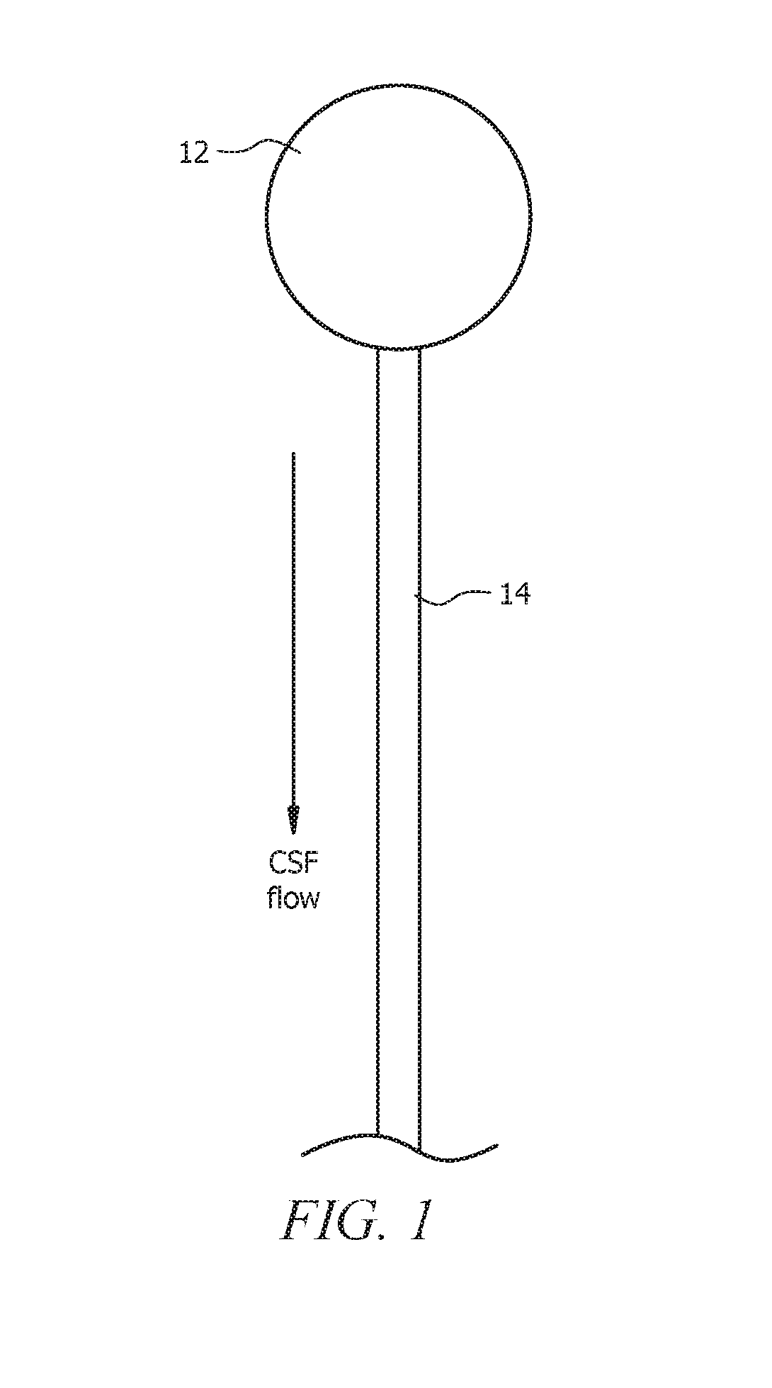 Shunt catheter system