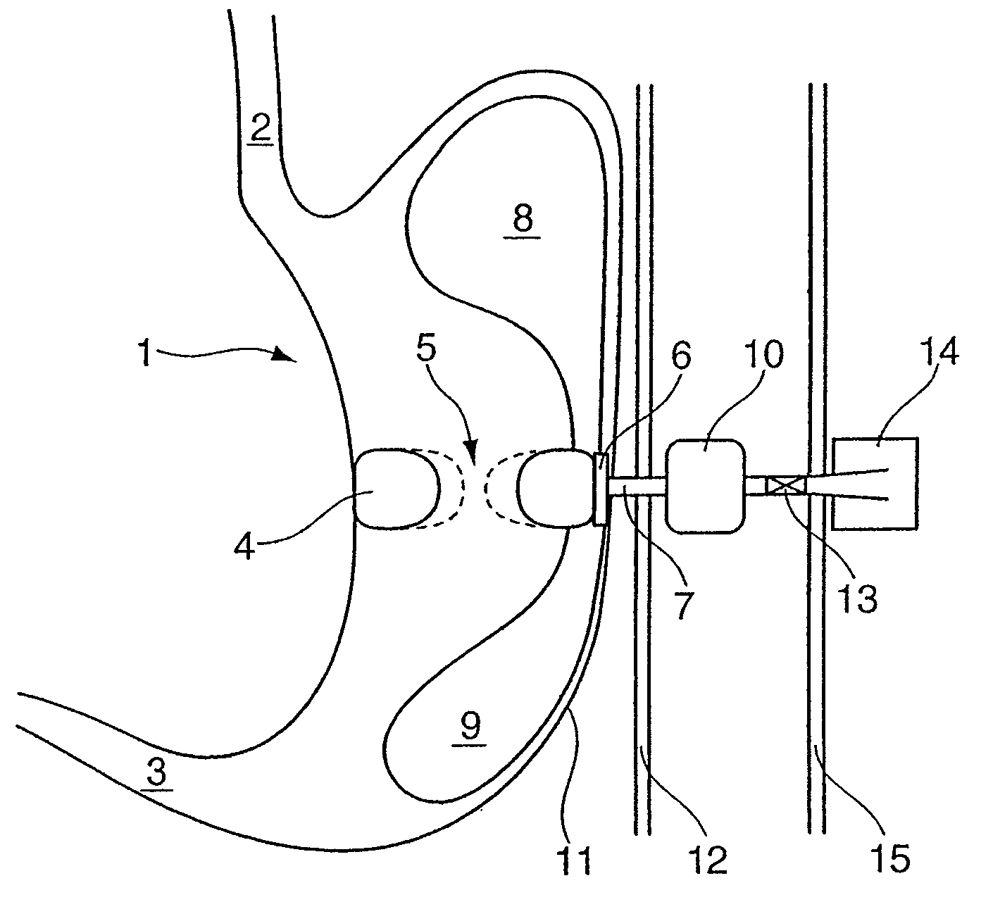 Device for treating obesity