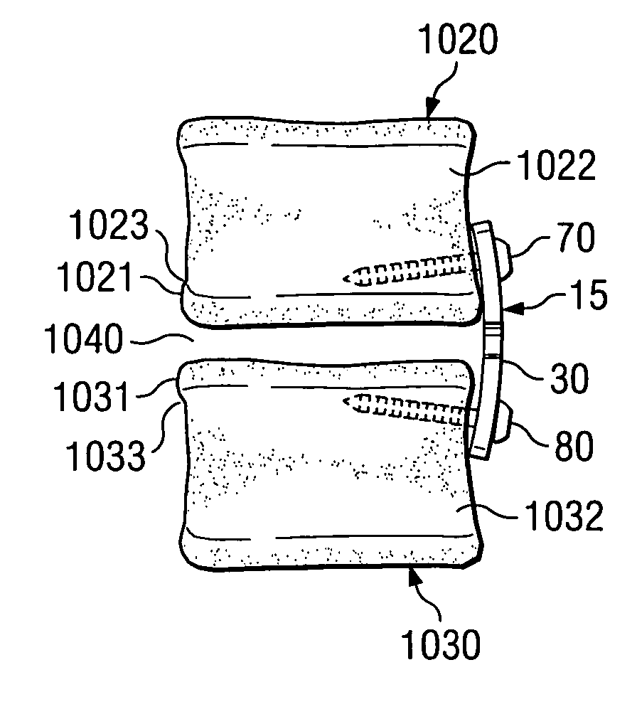 Bone alignment implant and method of use