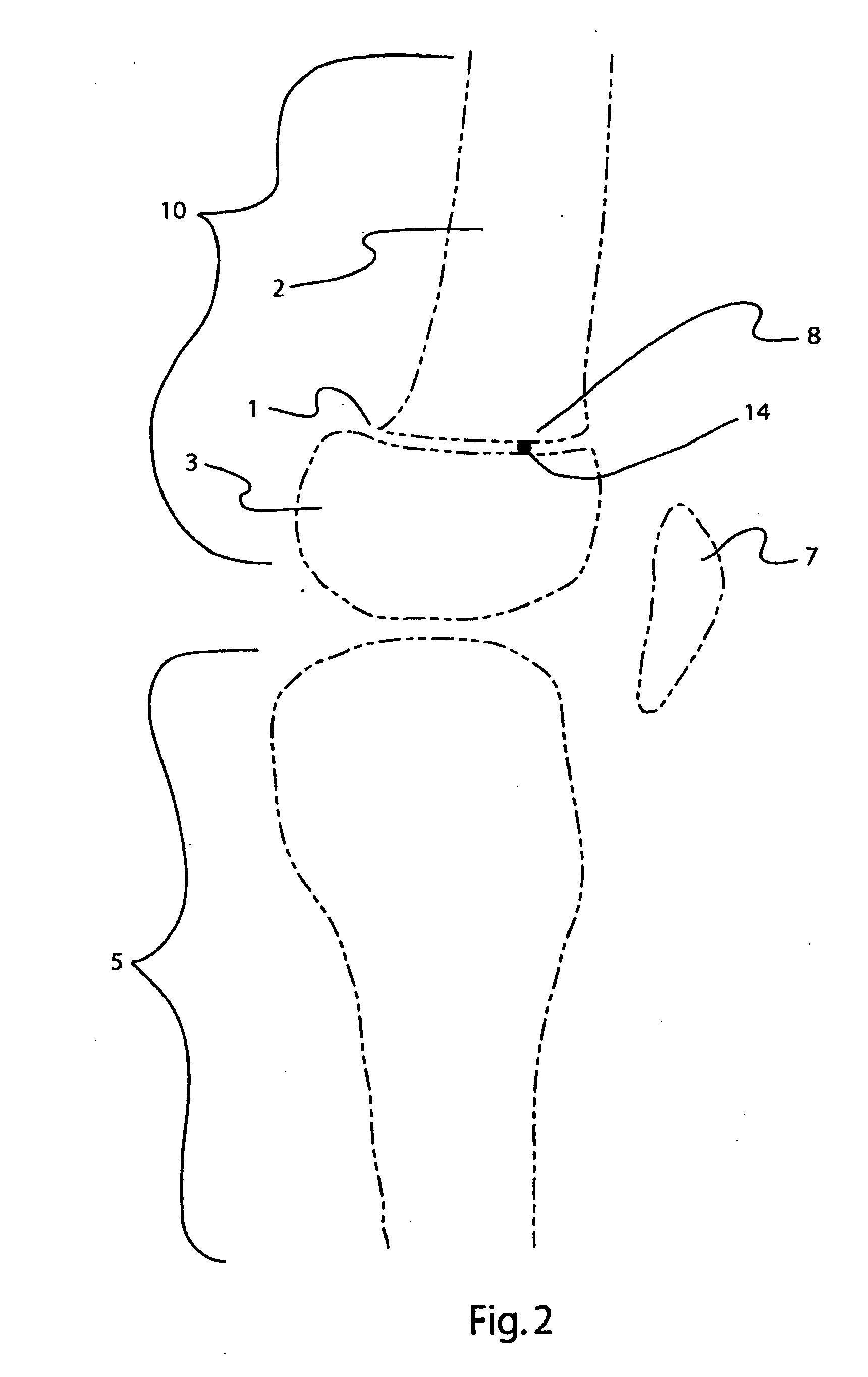 Bone alignment implant and method of use