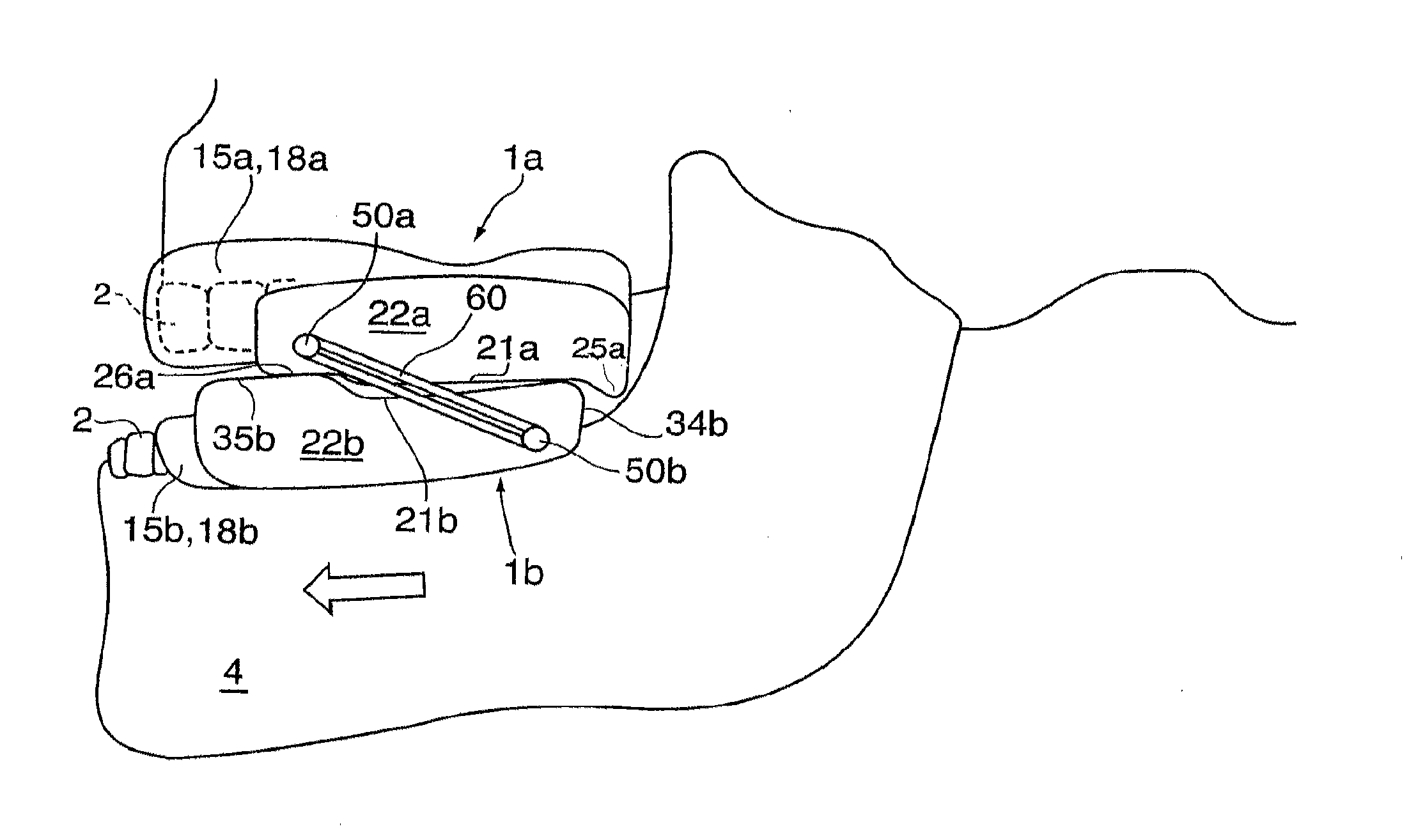 Removable bite plane appliance