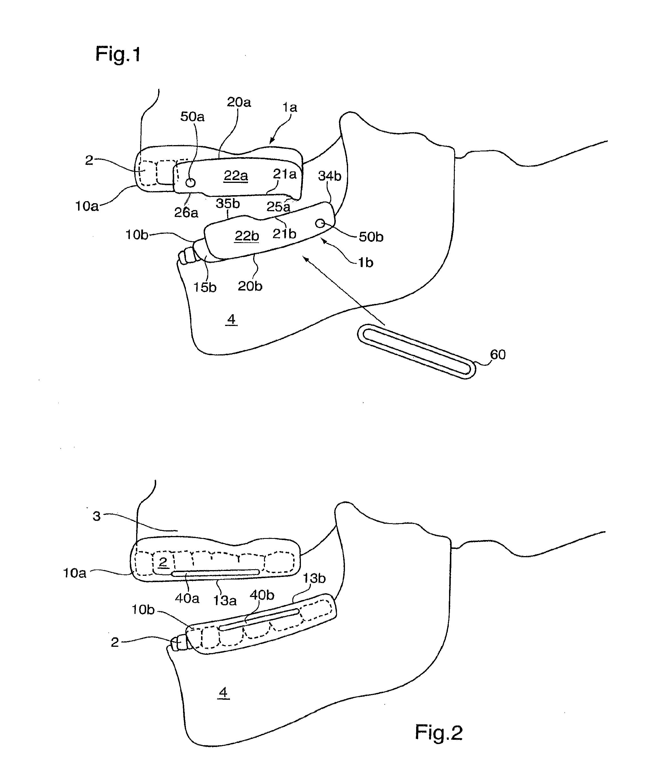 Removable bite plane appliance