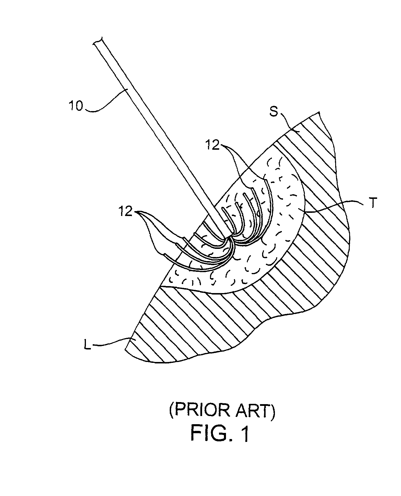 Apparatus and method for treating tumors near the surface of an organ