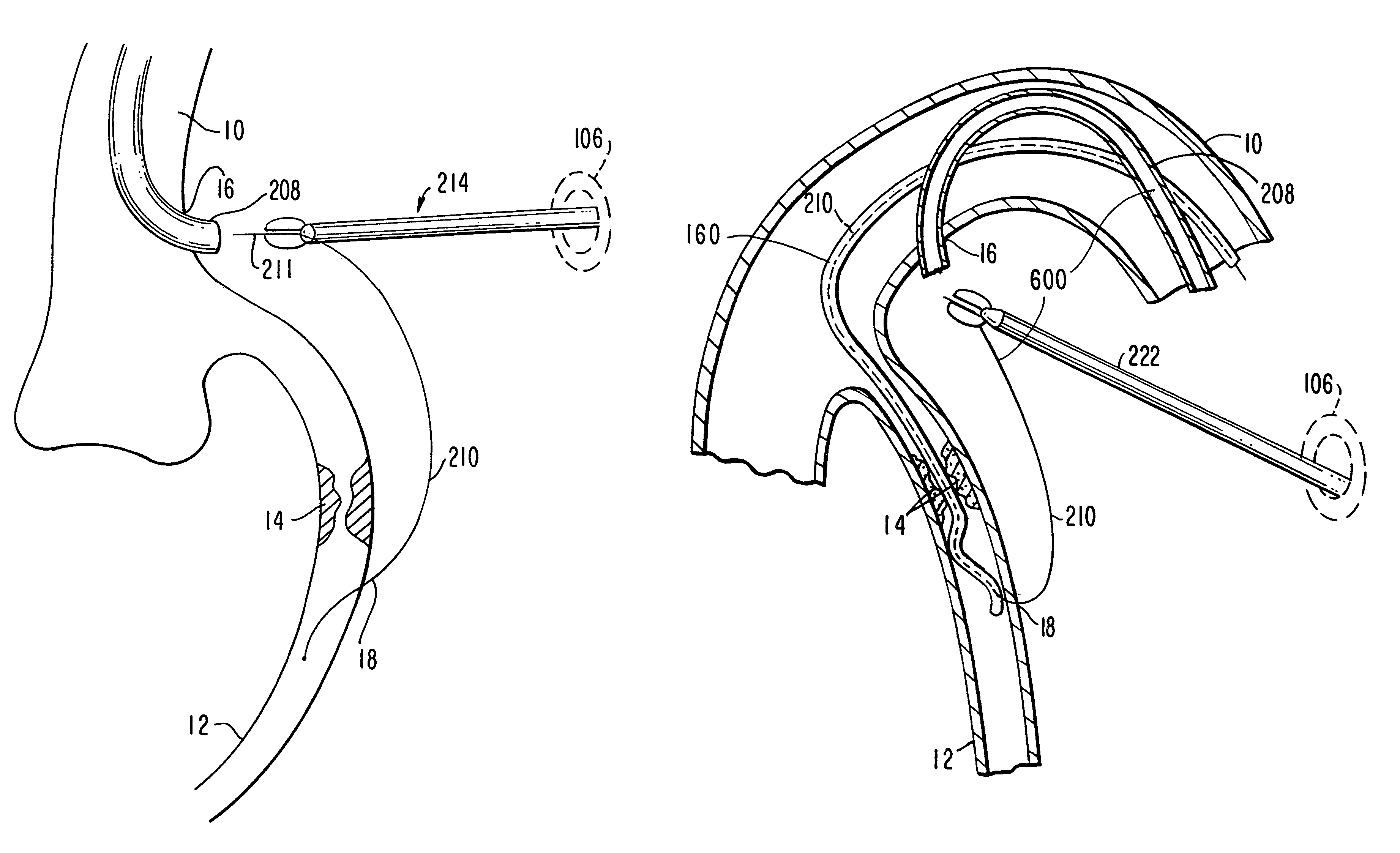 Medical grafting methods and apparatus