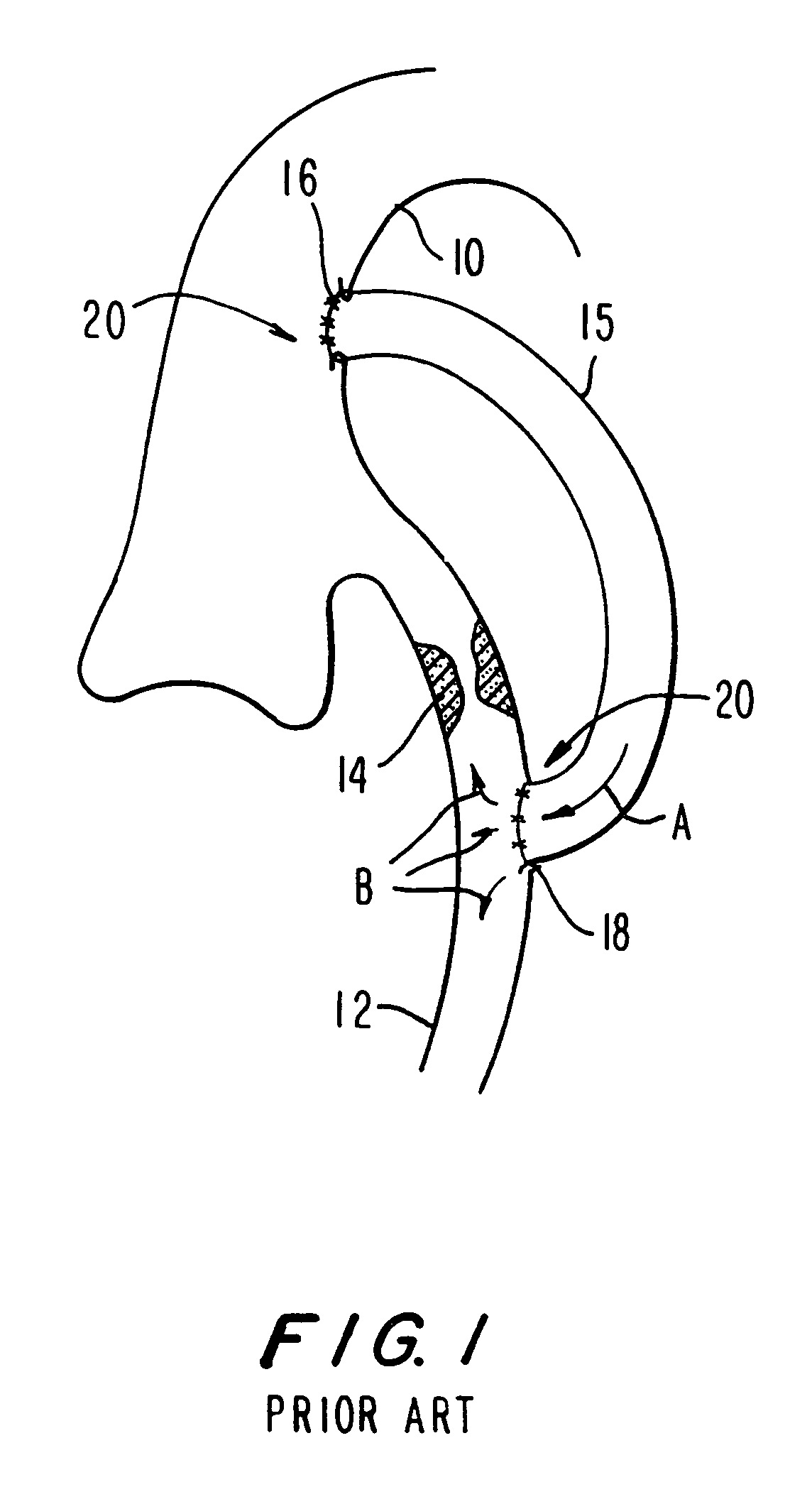 Medical grafting methods and apparatus