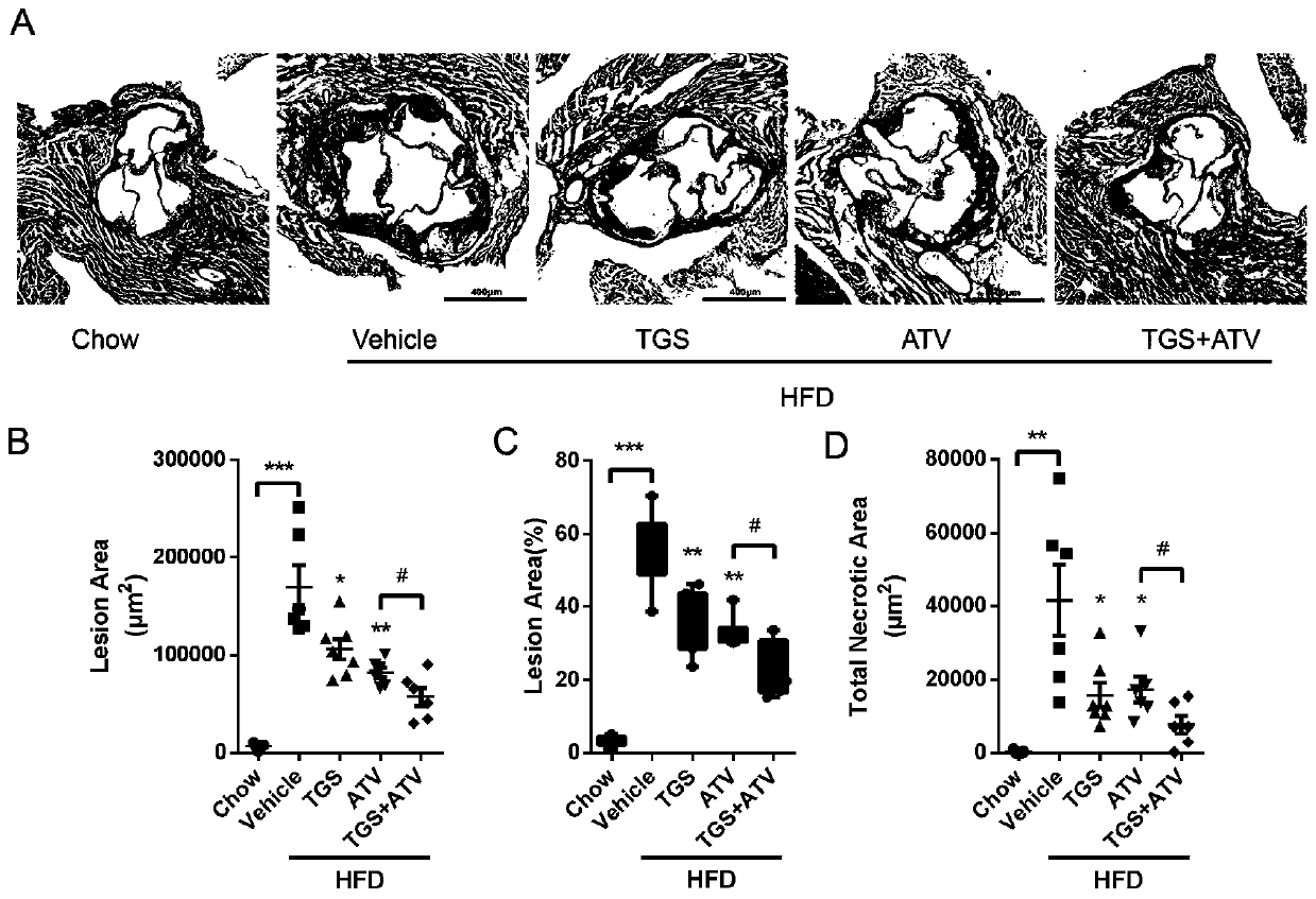 Drug combination for treating hyperglycemia complicated with atherosclerosis and application thereof