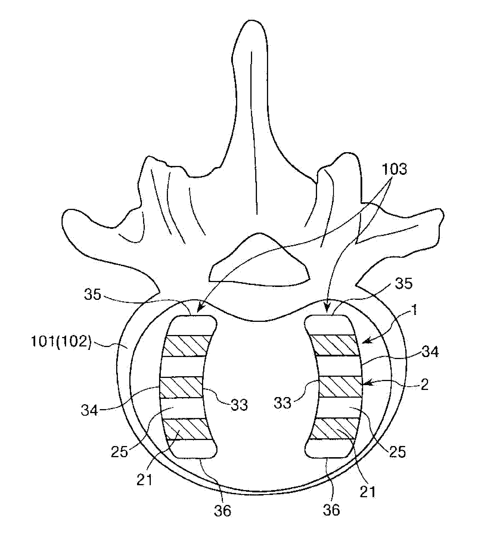 Vertebral body spacer