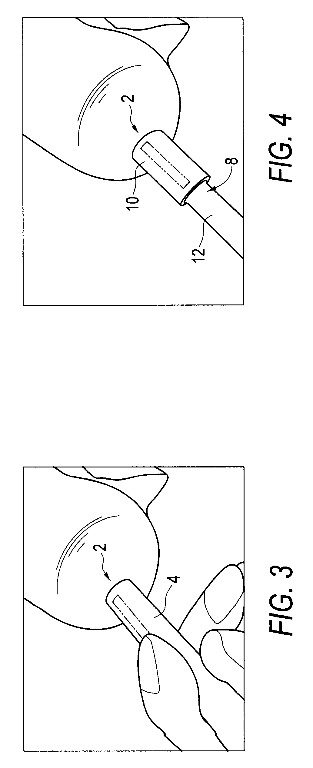 Preformed implants for osteochondral repair