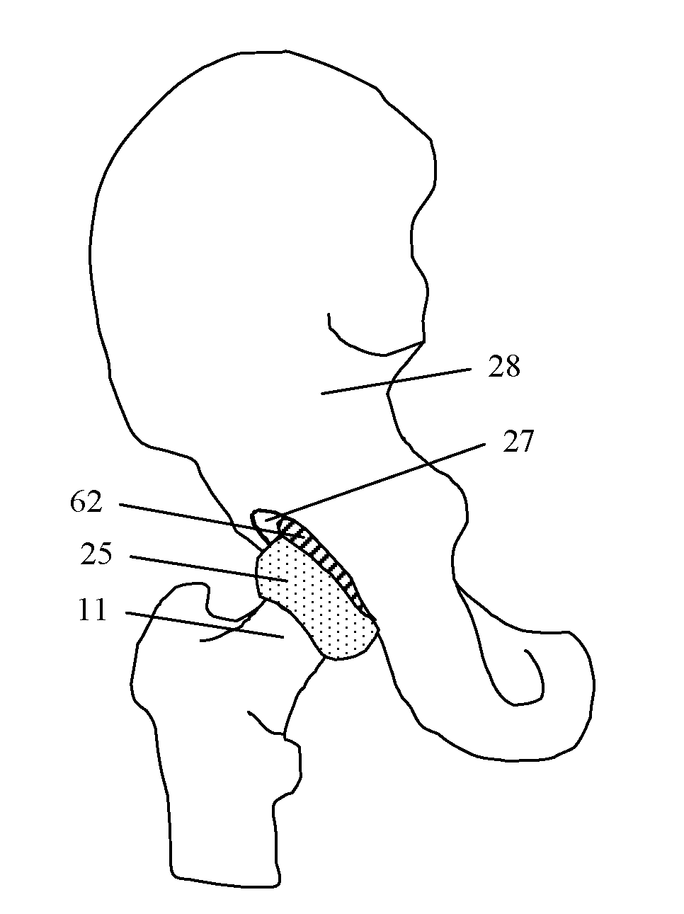 Resilient interpositional hip arthroplasty device