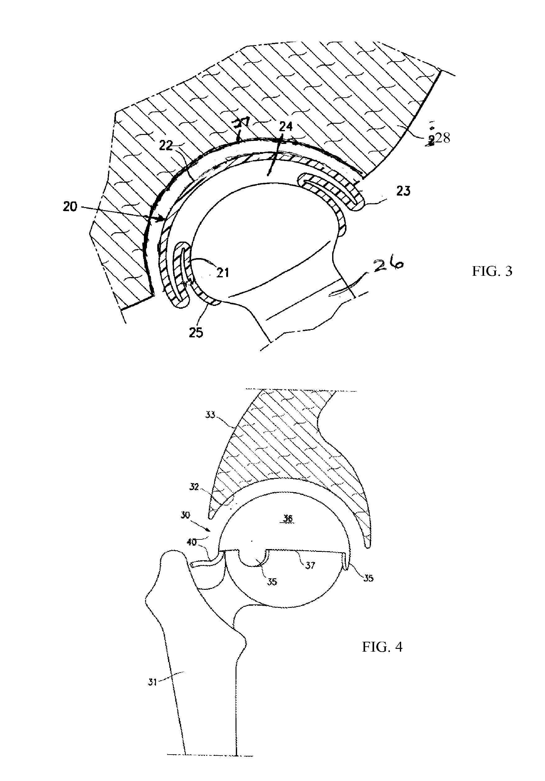 Resilient interpositional hip arthroplasty device