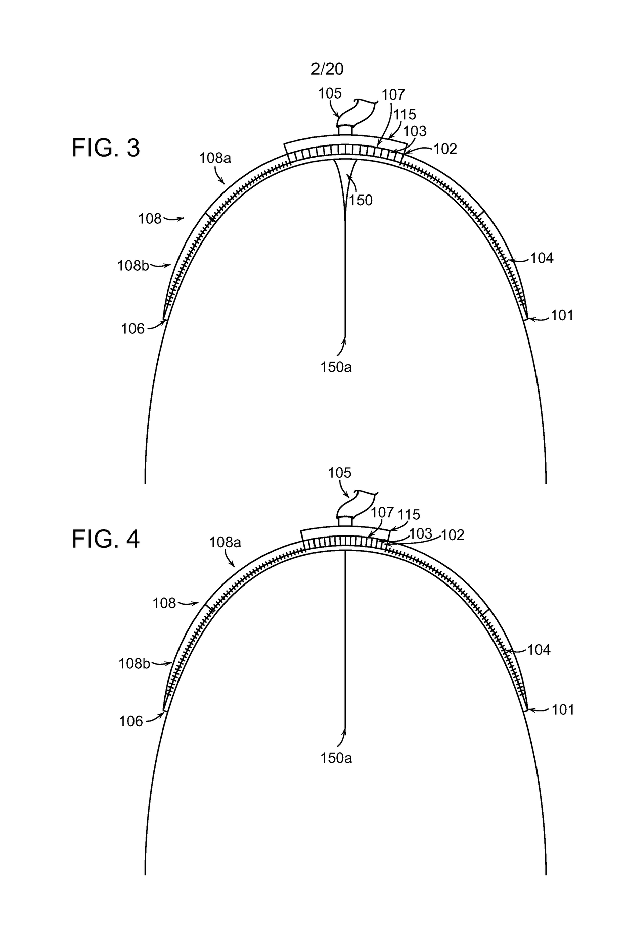 Negative pressure wound closure devices and methods