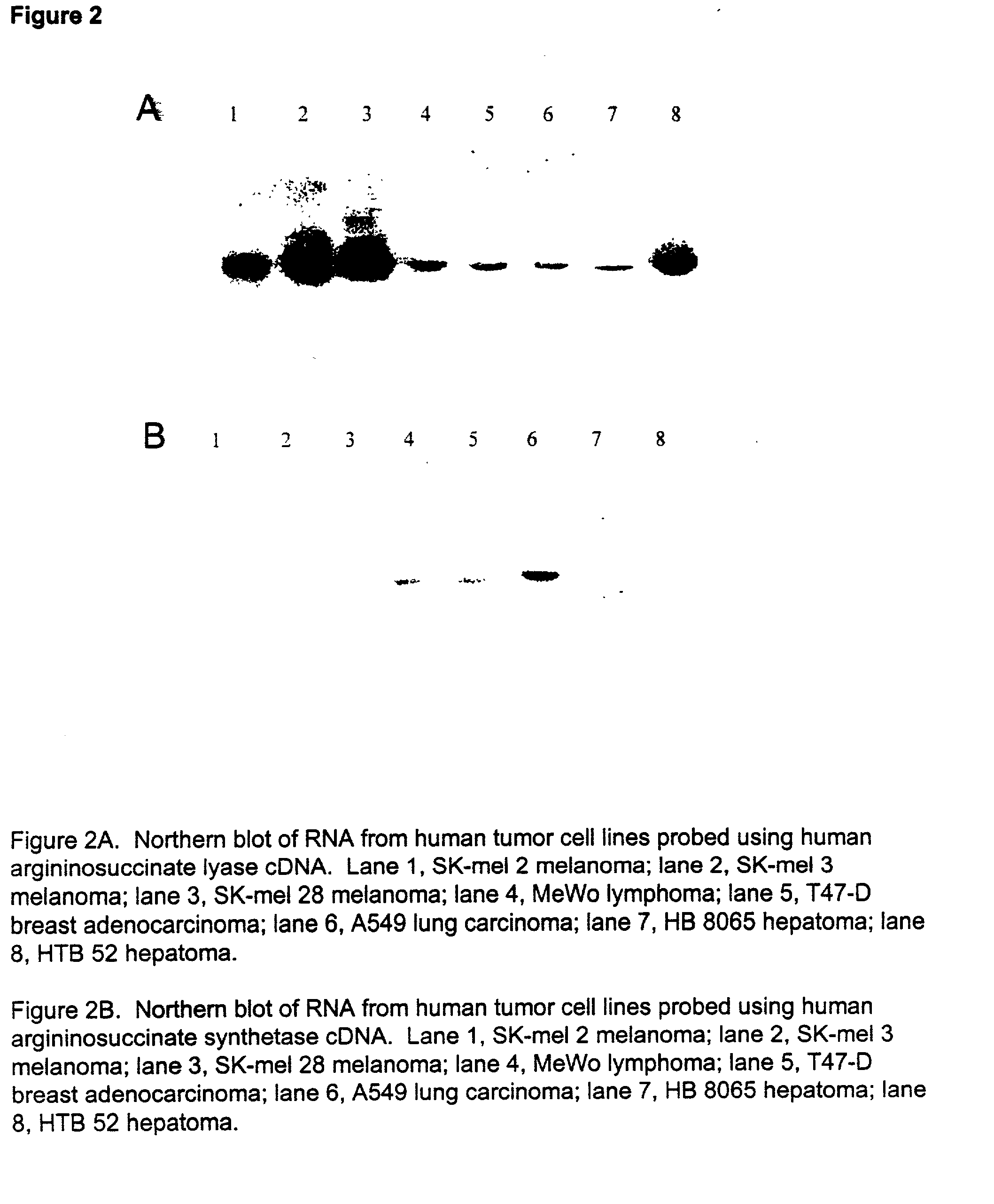 Methods for predicting sensitivity of tumors to arginine deprivation