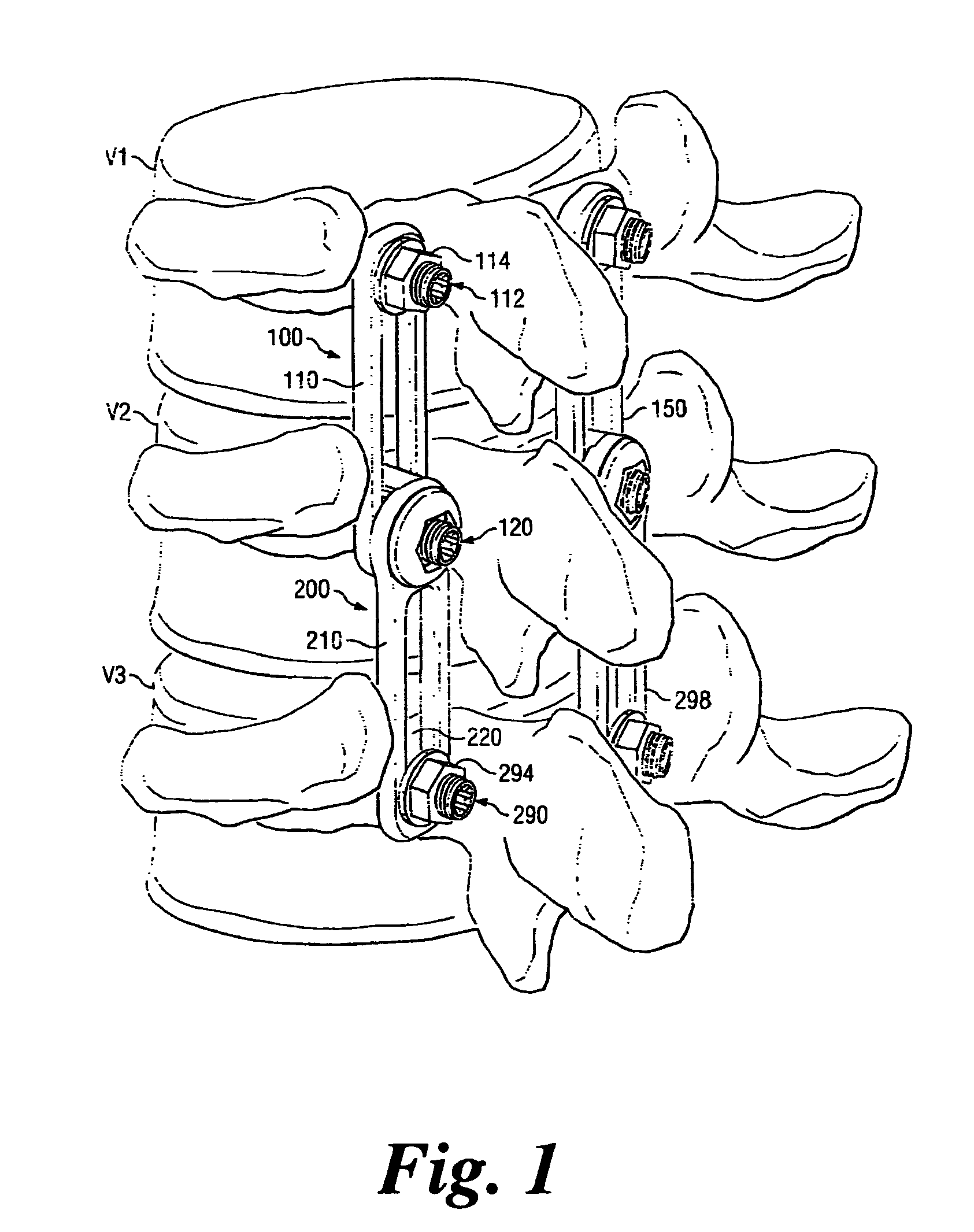 Revision fixation plate and method of use