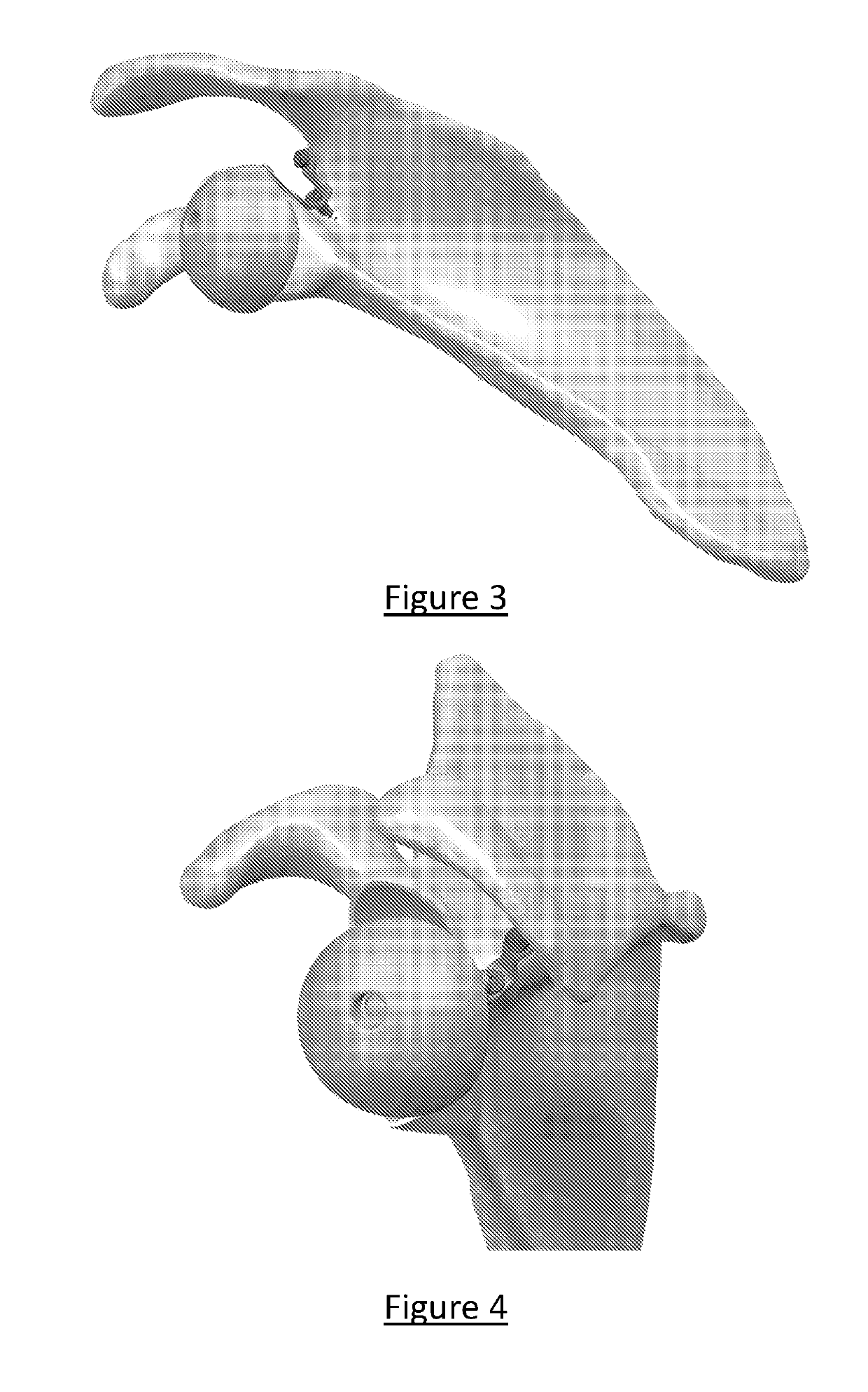 Platform rtsa glenoid prosthesis with modular attachments capable of improving initial fixation, fracture reconstructions, and joint biomechanics