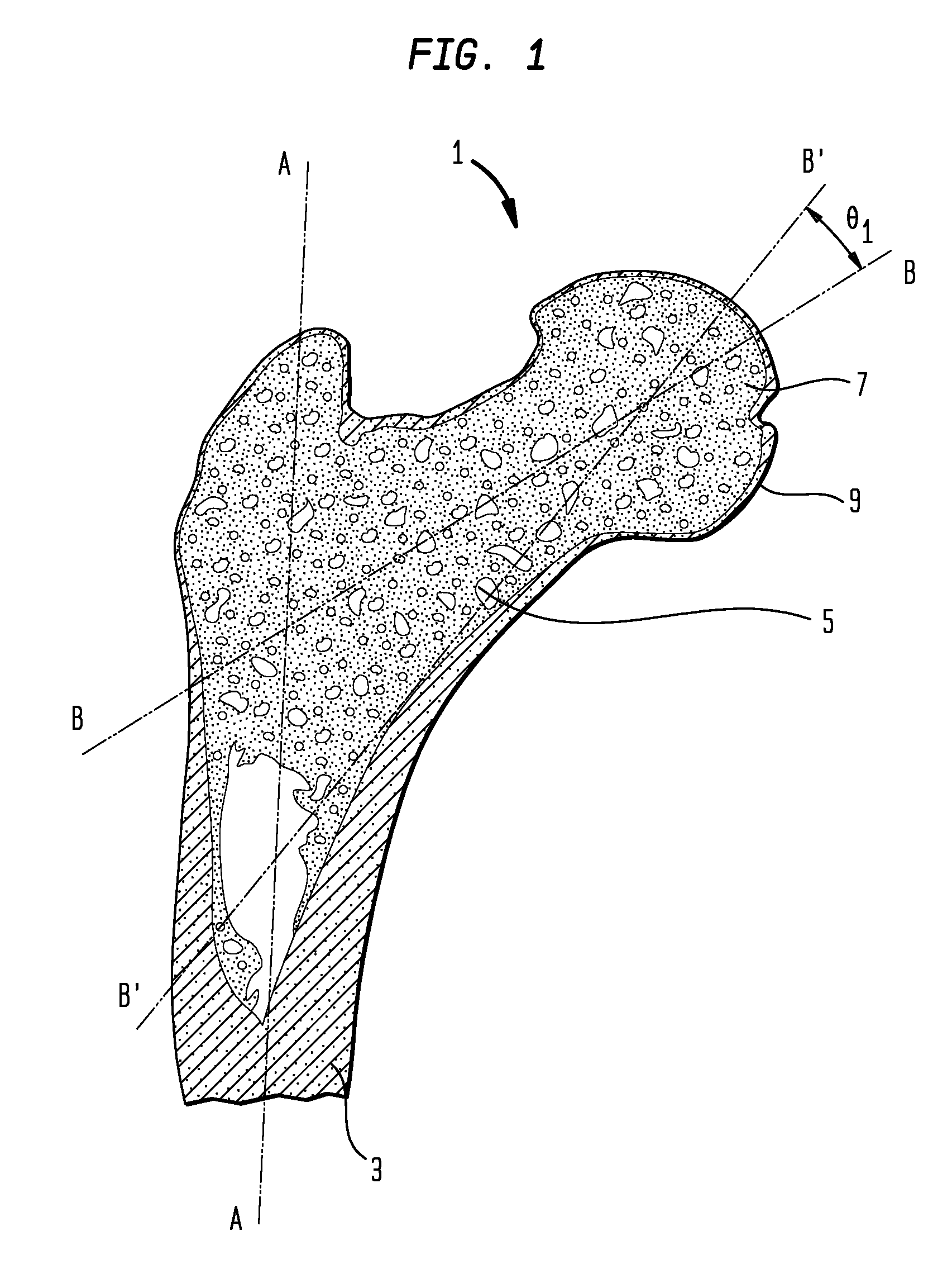 Femoral head resurfacing