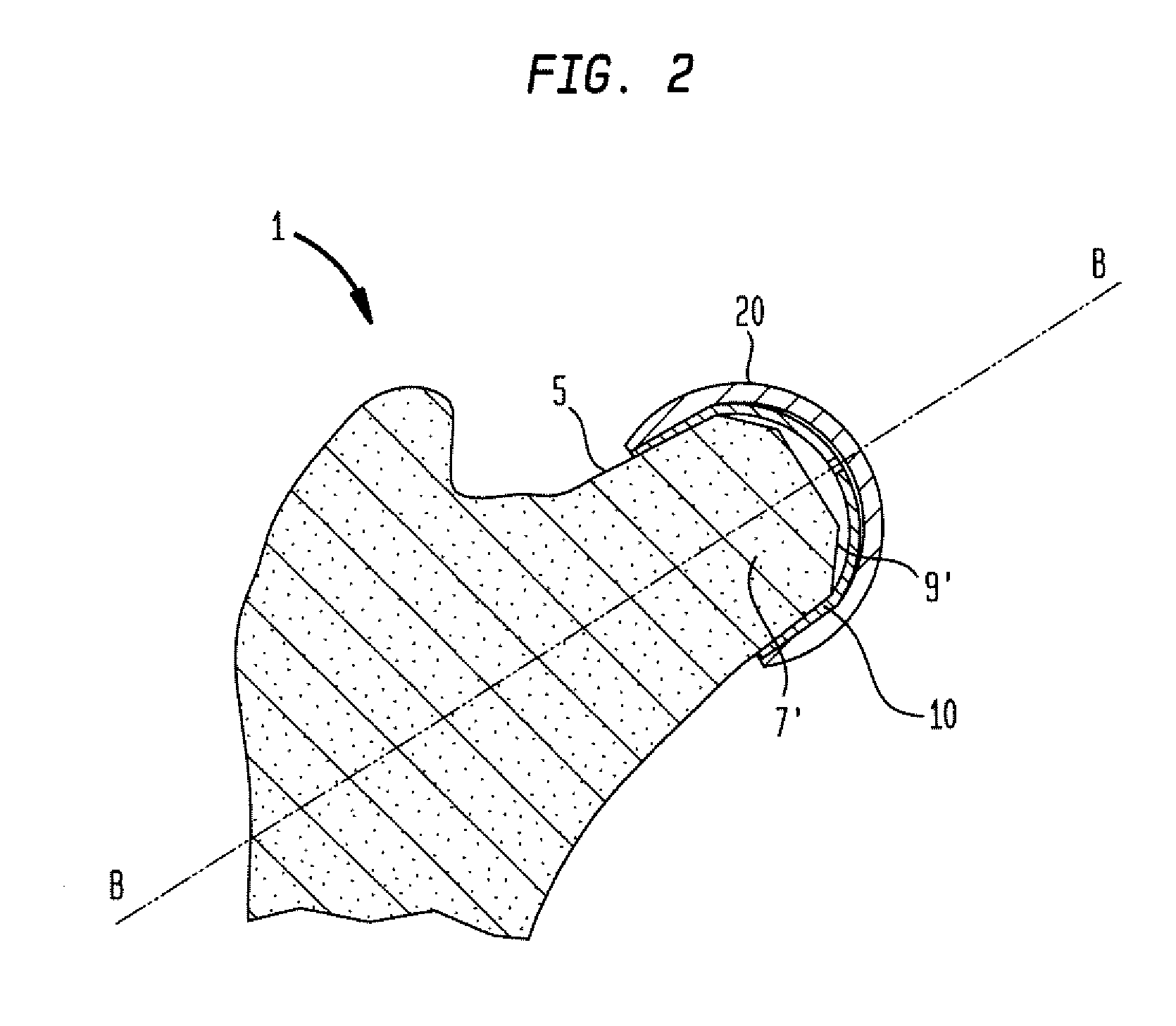 Femoral head resurfacing