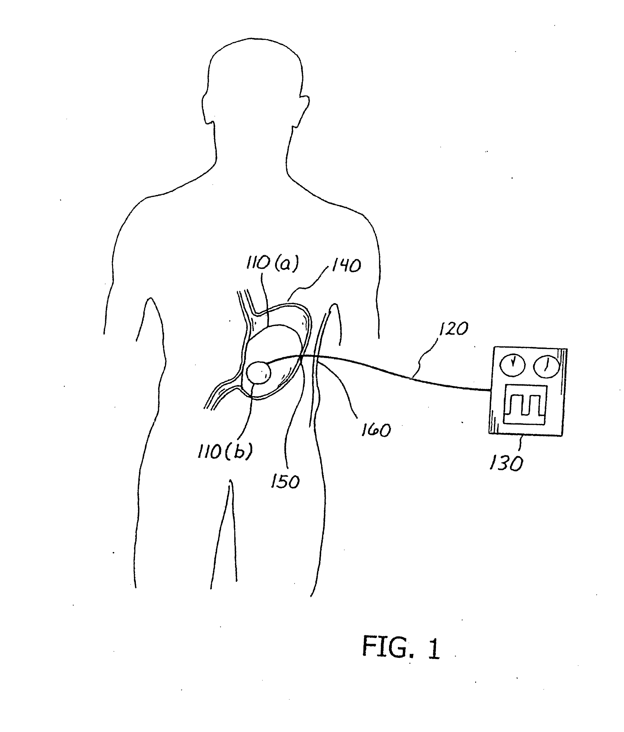 Balloon system and methods for treating obesity