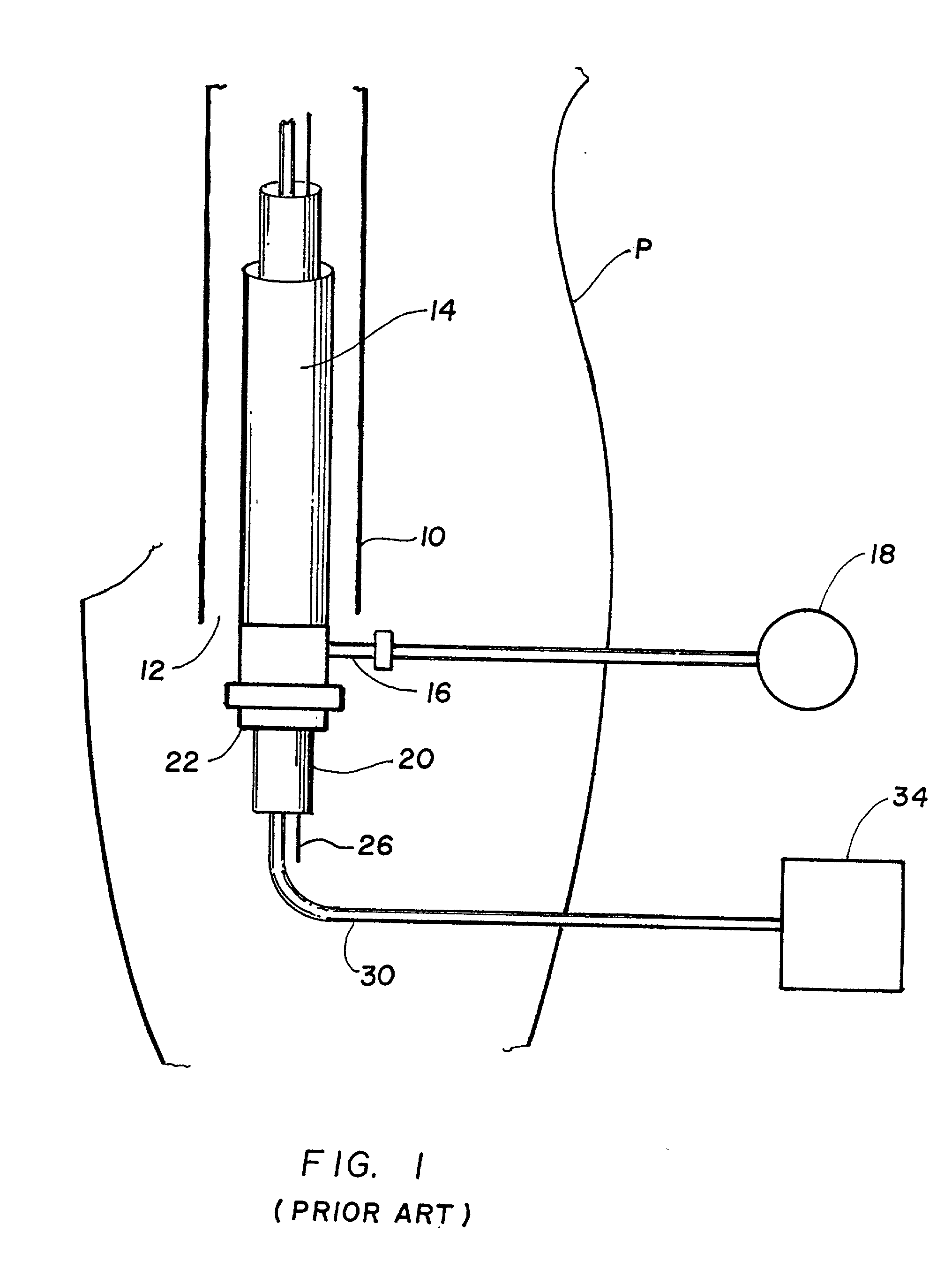 Perfusion procedure and apparatus for preventing necrosis following failed balloon angioplasty