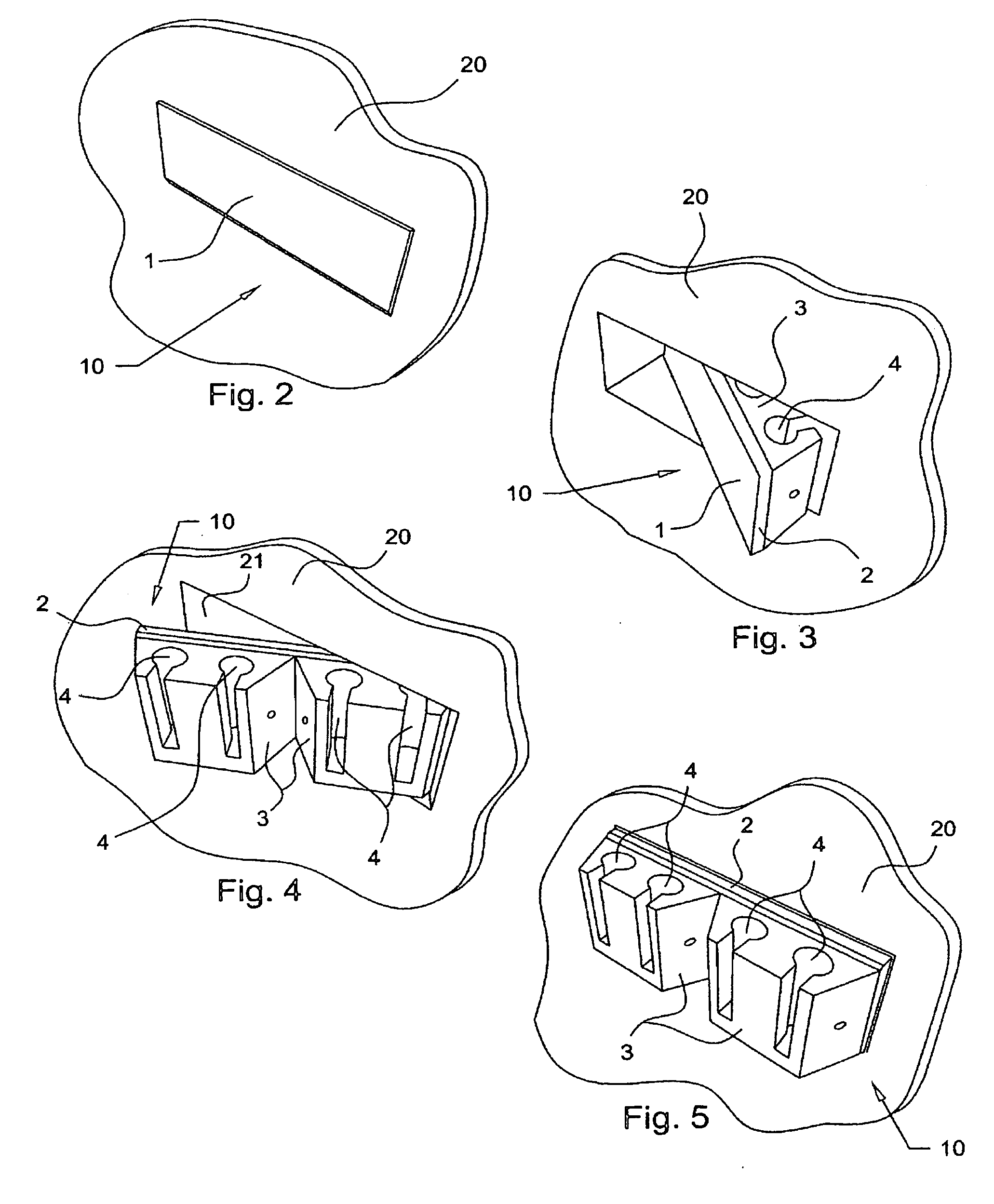 Universal Feature Attachment System