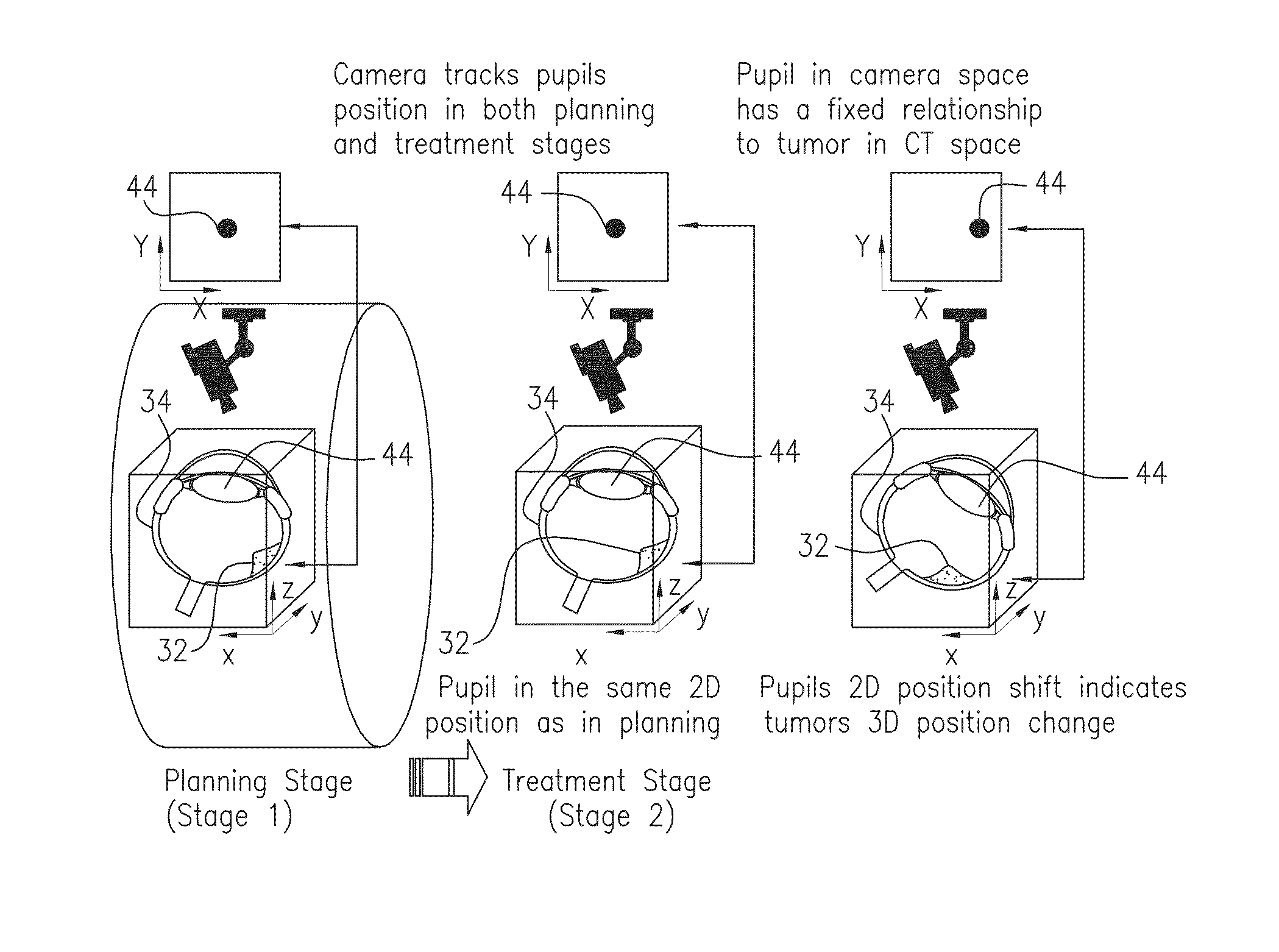 Radiation therapy device for ocular melanoma