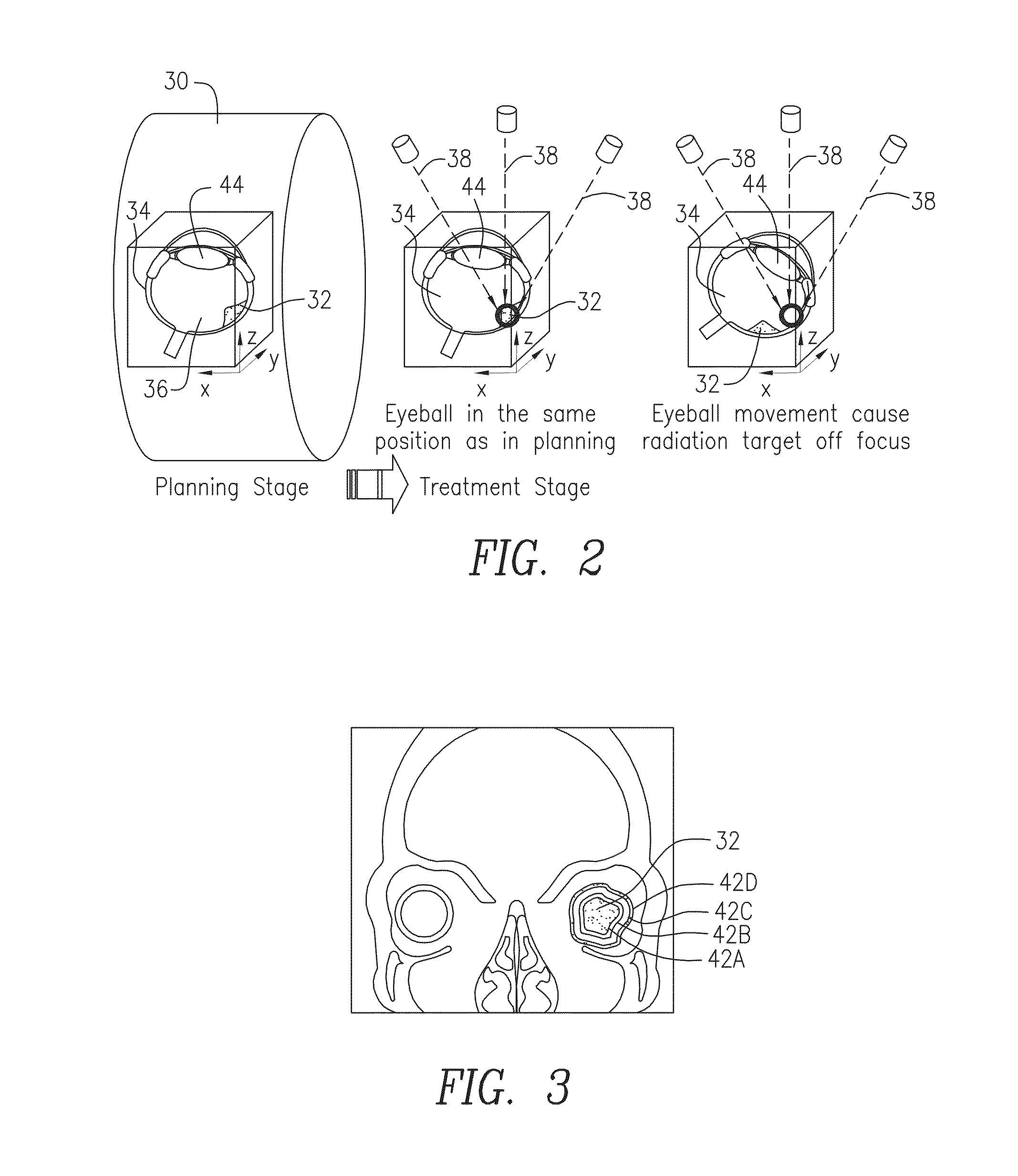 Radiation therapy device for ocular melanoma