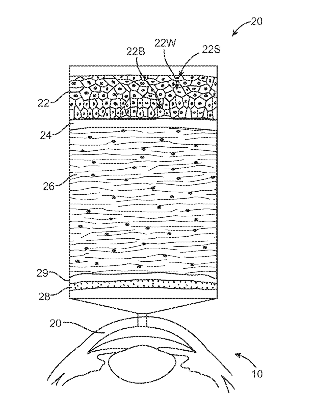 Corneal denervation for treatment of ocular pain