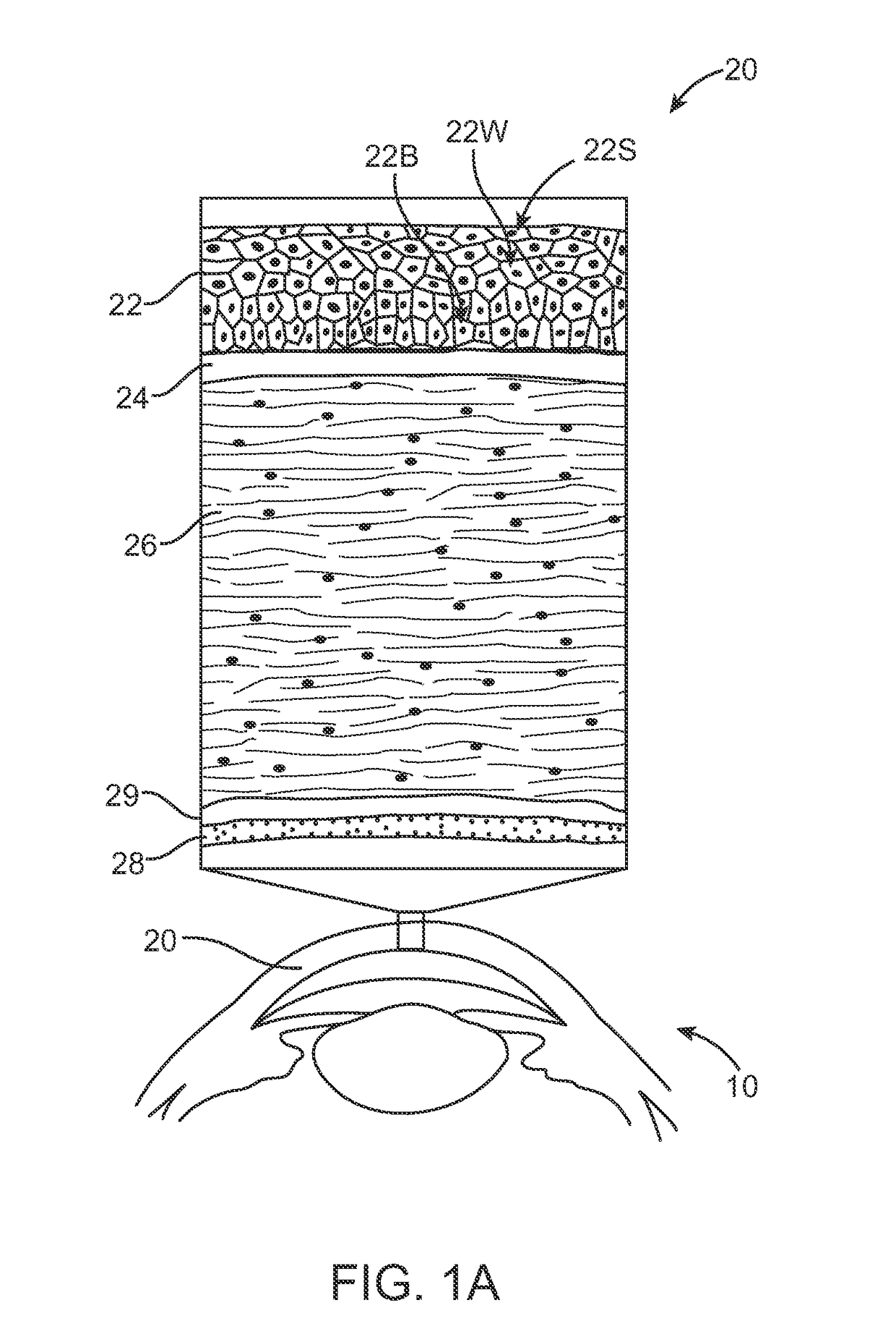 Corneal denervation for treatment of ocular pain