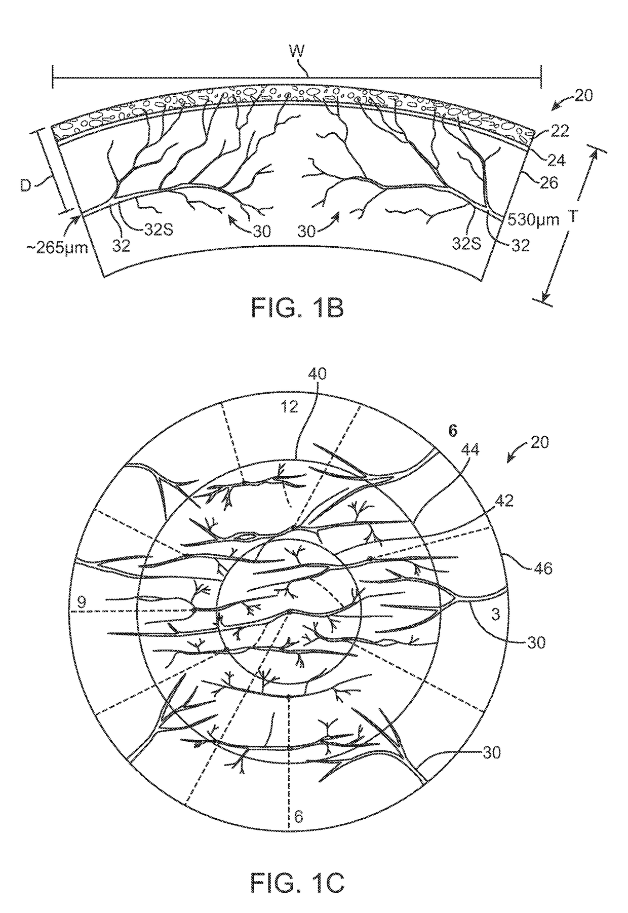 Corneal denervation for treatment of ocular pain