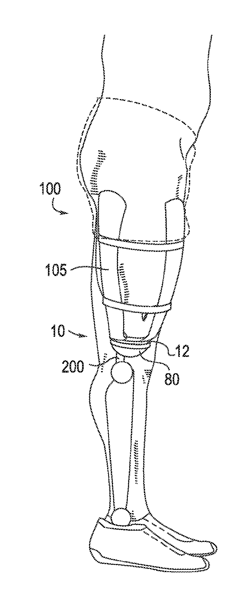 Alignable coupling assembly for connecting two prosthetic limb components