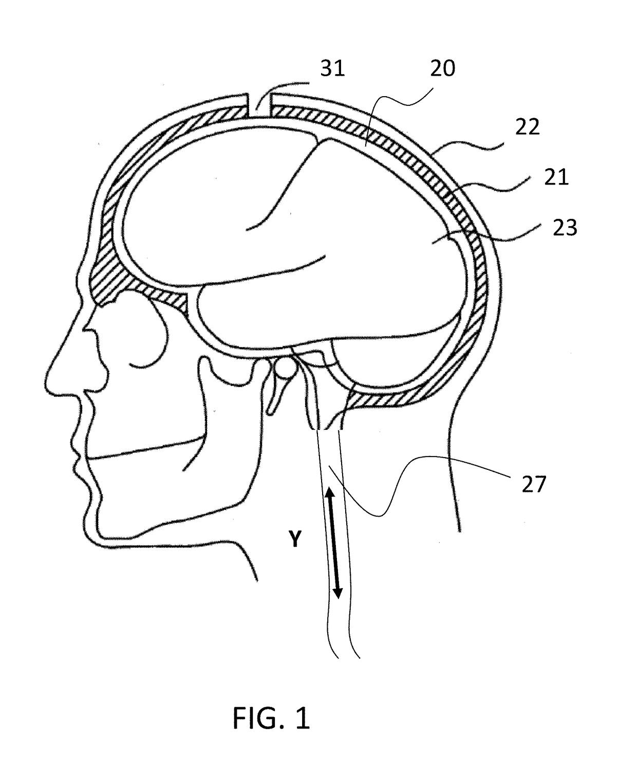 Apparatus and methods for detecting increase in intracranial pressure