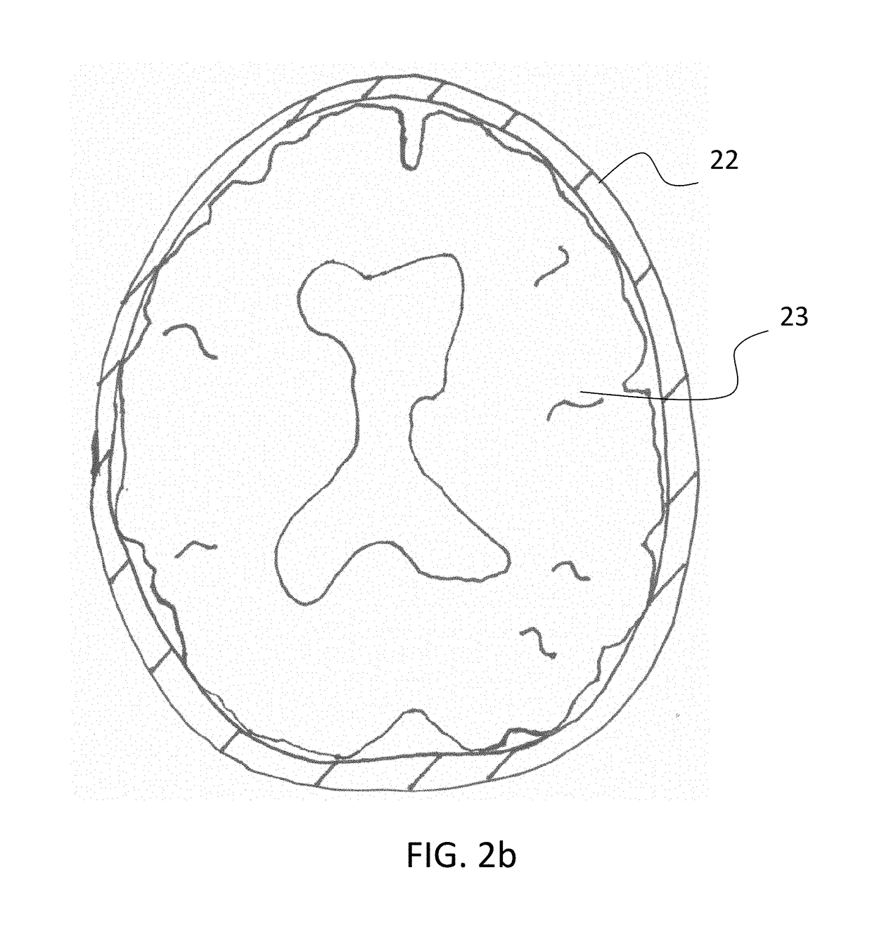 Apparatus and methods for detecting increase in intracranial pressure