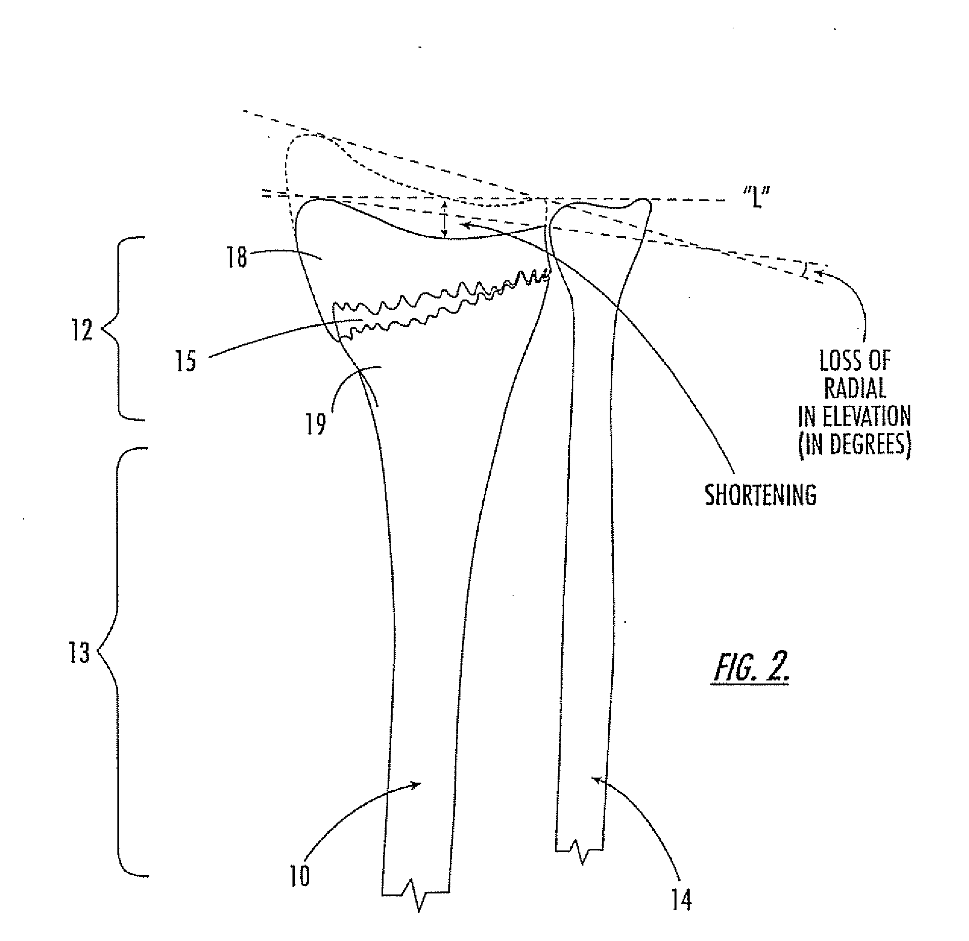 Kits with intramedullary interlocking fixation devices for the distal radius