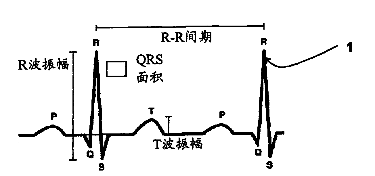 Electrocardiogram derived apnoea/hypopnea index