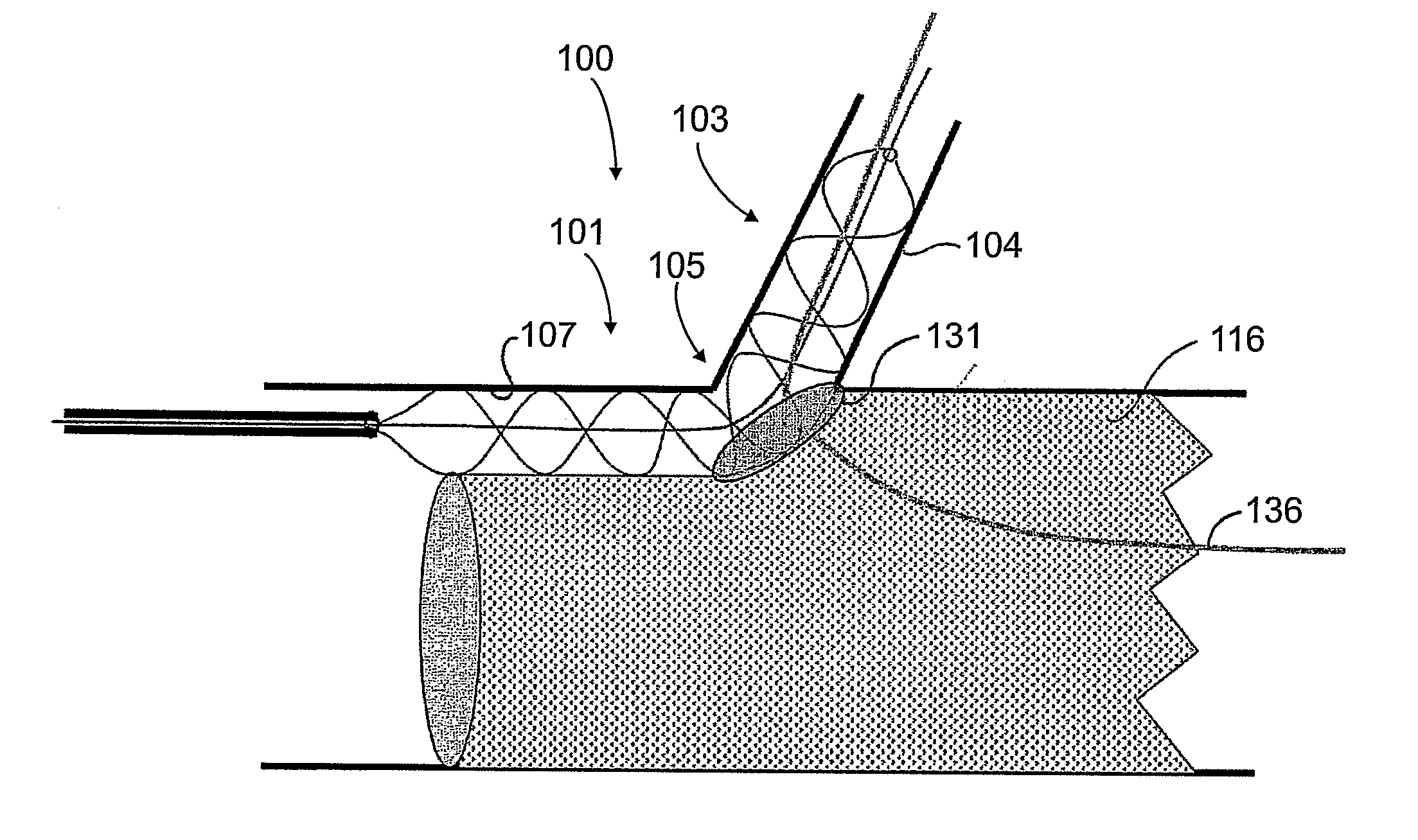 Stent graft fenestration